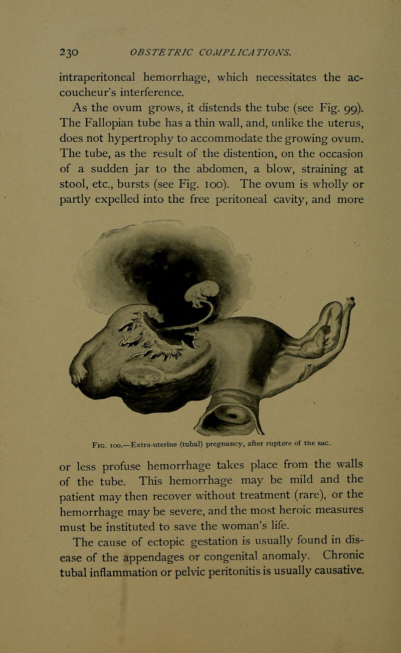 intraperitoneal hemorrhage, which necessitates the ac- coucheur's interference. As the ovum grows, it distends the tube (see Fig. 99). The Fallopian tube has a thin wall, and, unlike the uterus, does not hypertrophy to accommodate the growing ovum. The tube, as the result of the distention, on the occasion of a sudden jar to the abdomen, a blow, straining at stool, etc., bursts (see Fig. 100). The ovum is wholly or partly expelled into the free peritoneal cavity, and more Fig. 100.—Extra-uterine (tubal) pregnancy, after rupture of the sac or less profuse hemorrhage takes place from the walls of the tube. This hemorrhage may be mild and the patient may then recover without treatment (rare), or the hemorrhage, may be severe, and the most heroic measures must be instituted to save the woman's life. The cause of ectopic gestation is usually found in dis- ease of the appendages or congenital anomaly. Chronic tubal inflammation or pelvic peritonitis is usually causative.