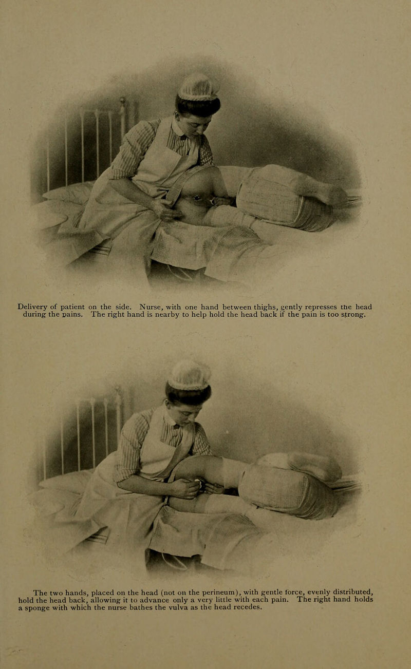 Delivery of patient on the side. Nurse, with one hand between thighs, gently represses the head during the pains. The right hand is nearby to help hold the head back if the pain is too strong. * The two hands, placed on the head (not on the perineum), with gentle lorce, evenly distributed, hold the head back, allowing it to advance only a very little with each pain. The right hand holds a sponge with which the nurse bathes the vulva as the head recedes.