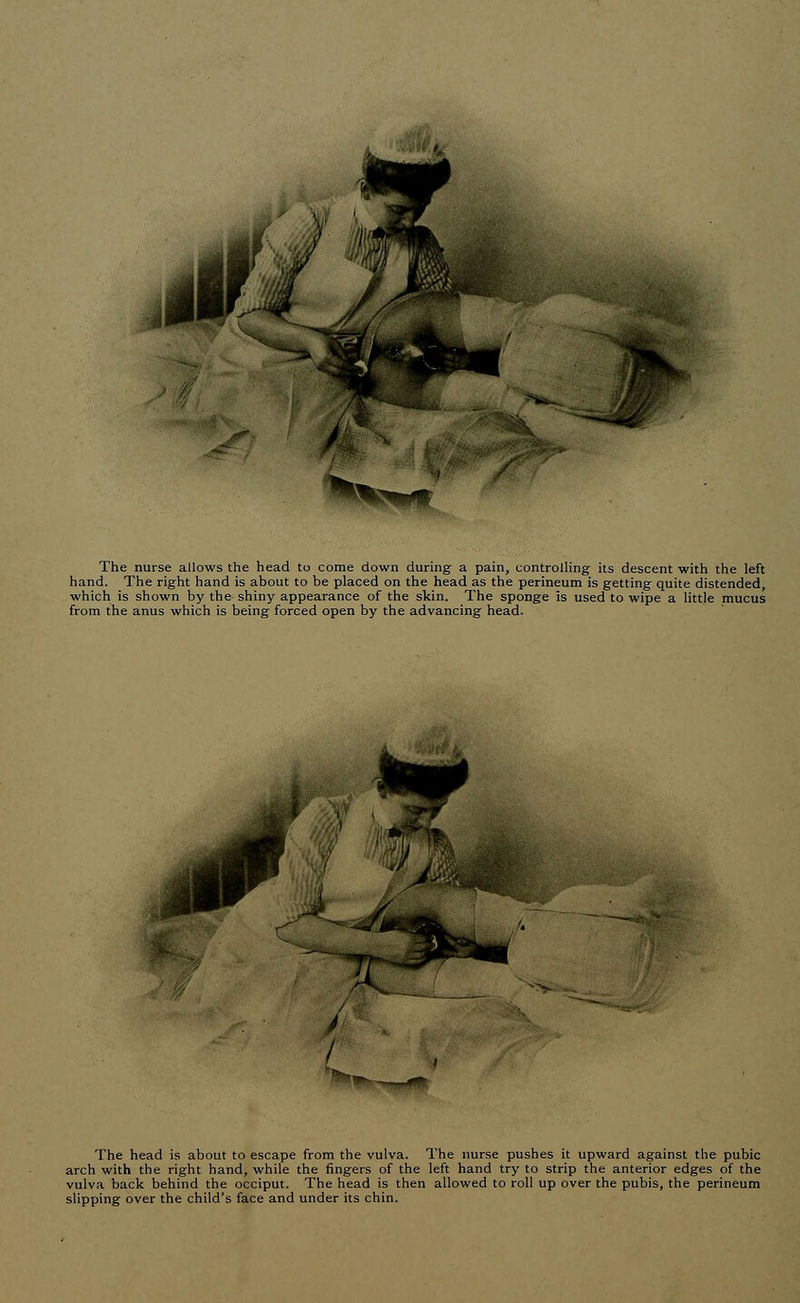 * The nurse allows the head to come down during a pain, controlling its descent with the left hand. The right hand is about to be placed on the head as the perineum is getting quite distended, which is shown by the shiny appearance of the skin. The sponge is used to wipe a little mucus from the anus which is being forced open by the advancing head. f ' < »3t y* a The head is about to escape from the vulva. The nurse pushes it upward against the pubic arch with the right hand, while the fingers of the left hand try to strip the anterior edges of the vulva back behind the occiput. The head is then allowed to roll up over the pubis, the perineum slipping over the child's face and under its chin.