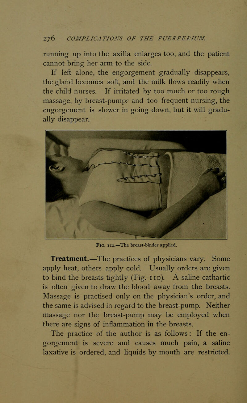 running up into the axilla enlarges too, and the patient cannot bring her arm to the side. If left alone, the engorgement gradually disappears, the gland becomes soft, and the milk flows readily when the child nurses. If irritated by too much or too rough massage, by breast-pump? and too frequent nursing, the engorgement is slower in going down, but it will gradu- ally disappear. Fig. no.—The breast-binder applied. Treatment.—The practices of physicians vary. Some apply heat, others apply cold. Usually orders are given to bind the breasts tightly (Fig. no). A saline cathartic is often given to draw the blood away from the breasts. Massage is practised only on the physician's order, and the same is advised in regard to the breast-pump. Neither massage nor the breast-pump may be employed when there are signs of inflammation in the breasts. The practice of the author is as follows: If the en- gorgement is severe and causes much pain, a saline laxative is ordered, and liquids by mouth are restricted.