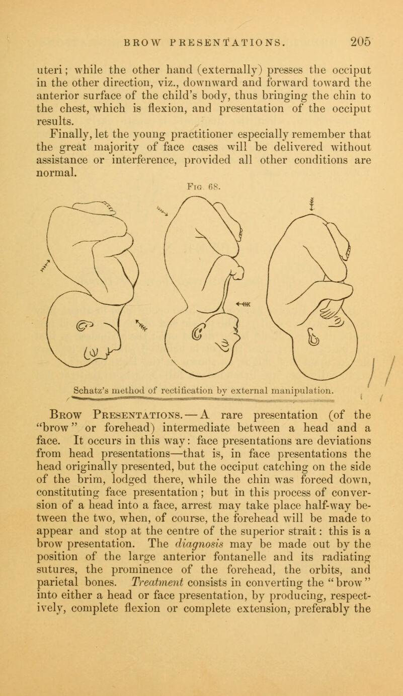 uteri; while the other hand (externally) presses the occiput in the other direction, viz., downward and forward toward the anterior surface of the child's body, thus bringing the chin to the chest, which is flexion, and presentation of the occiput results. Finally, let the young practitioner especially remember that the great majority of face cases will be delivered without assistance or interference, provided all other conditions are normal. Fig 68. Brow Presentations. — A rare presentation (of the brow or forehead) intermediate between a head and a face. It occurs in this way: face presentations are deviations from head presentations—that is, in face presentations the head originally presented, but the occiput catching on the side of the brim, lodged there, while the chin was forced down, constituting face presentation; but in this process of conver- sion of a head into a face, arrest may take place half-way be- tween the two, when, of course, the forehead will be made to appear and stop at the centre of the superior strait: this is a brow presentation. The diagnosis may be made out by the position of the large anterior fontanelle and its radiating sutures, the prominence of the forehead, the orbits, and parietal bones. Treatment consists in converting the brow into either a head or face presentation, by producing, respect- ively, complete flexion or complete extension, preferably the