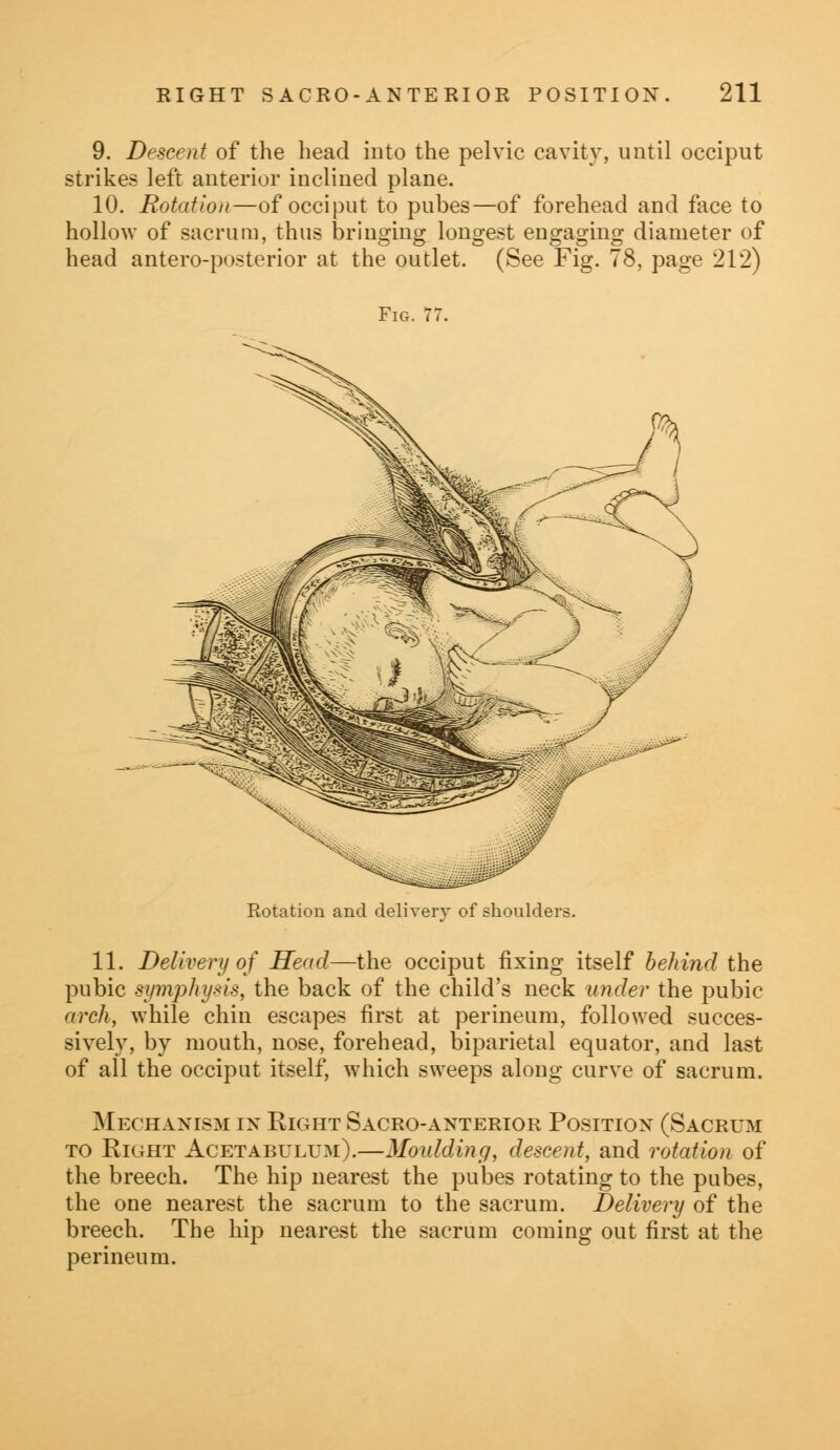 9. Descent of the head into the pelvic cavity, until occiput strikes left anterior inclined plane. 10. Botation—of occiput to pubes—of forehead and face to hollow of sacrum, thus bringing longest engaging diameter of head antero-posterior at the outlet. (See Fig. 78, page 212) Fig. 77. Rotation and delivery of shoulders. 11. Delivery of Head—the occiput fixing itself behind the pubic symphysis, the back of the child's neck under the pubic arch, while chin escapes first at perineum, followed succes- sively, by mouth, nose, forehead, biparietal equator, and last of all the occiput itself, which sweeps along curve of sacrum. Mechanism in Right Sacro-anterior Position (Sacrum to Right Acetabulum).—Moulding, descent, and rotation of the breech. The hip nearest the pubes rotating to the pubes, the one nearest the sacrum to the sacrum. Delivery of the breech. The hip nearest the sacrum coming out first at the perineum.