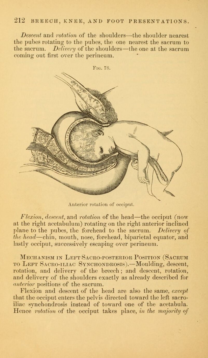 Descent and rotation of the shoulders—the shoulder nearest the pubes rotating to the pubes, the one nearest the sacrum to the sacrum. Delivery of the shoulders—the one at the sacrum coming out first over the perineum. Fig. 78. Anterior rotation of occiput. Flexion, descent, and rotation of the head—the occiput (now at the right acetabulum) rotating on the right anterior inclined plane to the pubes, the forehead to the sacrum. Delivery of the head—chin, mouth, nose, forehead, biparietal equator, and lastly occiput, successively escaping over perineum. Mechanism in Left Sacro-posterior Position (Sacrum to Left Sacro-iliac Synchondrosis).—Moulding, descent, rotation, and delivery of the breech; and descent, rotation, and delivery of the shoulders exactly as already described for <interior positions of the sacrum. Flexion and descent of the head are also the same, except that the occiput enters the pelvis directed toward the left sacro- iliac synchondrosis instead of toward one of the acetabula. Hence rotation of the occiput takes place, in the majority of