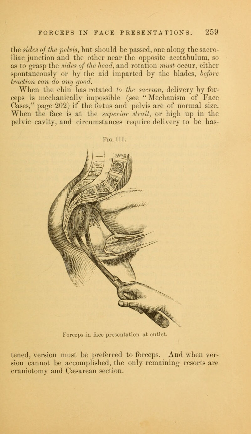 the sides of the pelvis, but should be passed, one along the sacro- iliac junction and the other near the opposite acetabulum, so as to grasp the sides of the head, and rotation must occur, either spontaneously or by the aid imparted by the blades, before traction can do any good. When the chin has rotated to the sacrum, delivery by for- ceps is mechanically impossible (see  Mechanism of Face Cases, page 202) if the foetus and pelvis are of normal size. When the face is at the superior strait, or high up in the pelvic cavity, and circumstances require delivery to be has- FlG. 111. Forceps in face presentation at outlet. tened, version must be preferred to forceps. And when ver- sion cannot be accomplished, the only remaining resorts are craniotomy and Cesarean section.