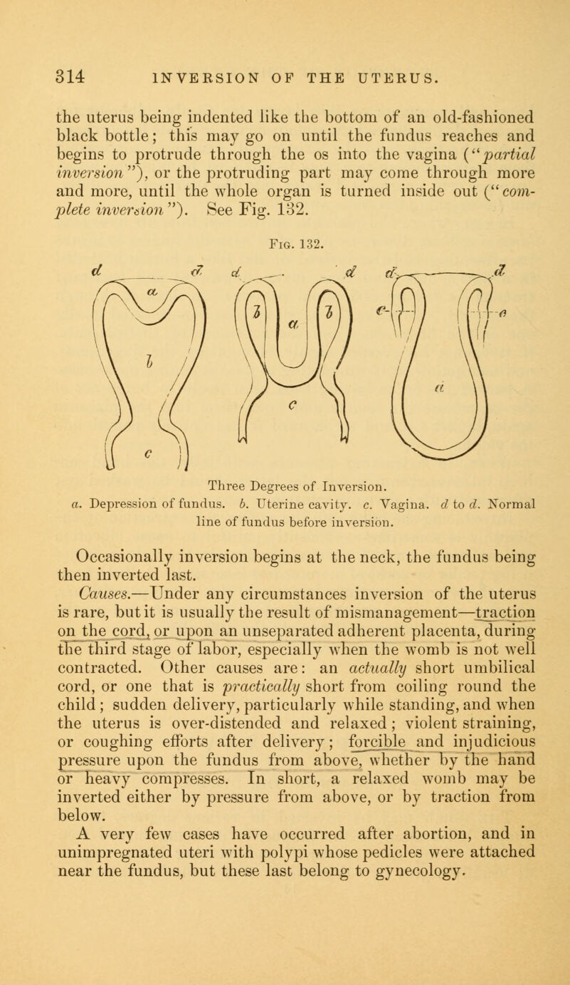 the uterus being indented like the bottom of an old-fashioned black bottle; this may go on until the fundus reaches and begins to protrude through the os into the vagina (partial inversion), or the protruding part may come through more and more, until the whole organ is turned inside out ( com- plete inversion). See Fig. 132. Fig. 132. Three Degrees of Inversion. a. Depression of fundus, b. Uterine cavity, c. Vagina, d to d. Normal line of fundus before inversion. Occasionally inversion begins at the neck, the fundus being then inverted last. Causes.—Under any circumstances inversion of the uterus is rare, but it is usually the result of mismanagement—traction on the cord, or upon an unseparated adherent placenta, during the third stage of labor, especially when the womb is not well contracted. Other causes are: an actually short umbilical cord, or one that is practically short from coiling round the child ; sudden delivery, particularly while standing, and when the uterus is over-distended and relaxed; violent straining, or coughing efforts after delivery; forcible and injudicious pressure upon the fundus from above, whether by the hand or heavy compresses. In short, a relaxed womb may be inverted either by pressure from above, or by traction from below. A very few cases have occurred after abortion, and in unimpregnated uteri with polypi whose pedicles were attached near the fundus, but these last belong to gynecology.