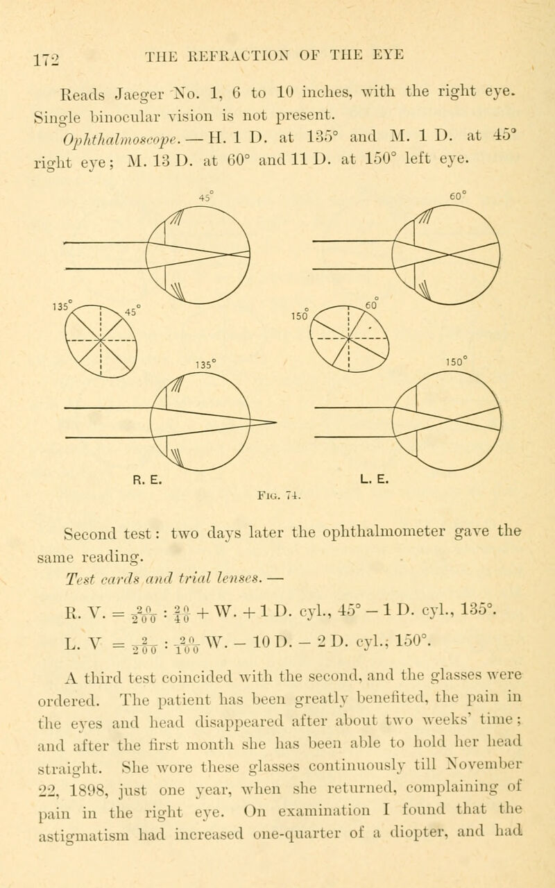 Reads Jaeger 'No. 1, 6 to 10 inches, with the right eye. gingle binocular vision is not present. Ophthalmoscope. — H. 1 D. at 135° and M. 1 D. at 15° rio-ht eve; M. 13 D. at 60° and 11 D. at 150° left eye. R. E. L. E. Fig. Second test: two days later the ophthalmometer gave the same reading. Test cards an<l trial lenses. — R. V. = jfo : f£ + W. +1 D. cyl., 45° - 11), cyl., 135°. L- V = ,h •- t¥o W- - 10 D- - - D' e3^ 150°. A third test coincided with the second, and the glasses were ordered. The patient has been greatly benefited, the pain in the eyes and head disappeared after about two weeks' time; and after the first month she lias been able to hold her head straight. She wore these -hisses continuously till November 22, 1898, just one year, when she returned, complaining of pain in the right eye. On examination I found that the astigmatism had increased one-quarter oi a diopter, and had