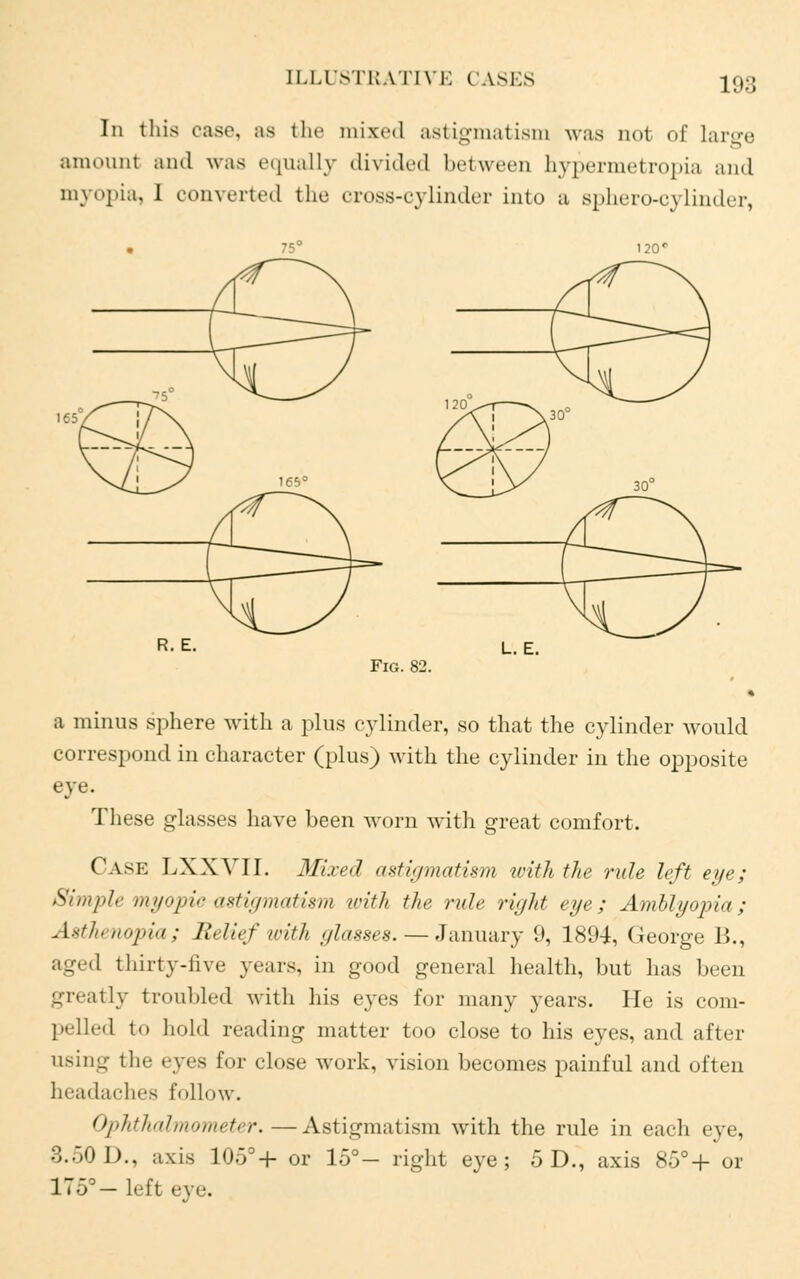 lie; In this ease, as the mixed astigmatism was not of large amount and was equally divided between hypermetropia and myopia, 1 converted the cross-cylinder into a sphero-cylinder, L. E. a minus sphere with a plus cylinder, so that the cylinder would correspond in character (plus) with the cylinder in the opposite eye. These glasses have been worn with great comfort. CASE LXXVII. Mixed astigmatism with the rule left eye; Simple myopic astigmatism with the rule right eye; Amblyopia; Asthenopia; Belief with glasses. — January 9, 1894, George 13., aged thirty-five years, in good general health, but has been greatly troubled with his eyes for many years. He is com- pelled to hold reading matter too close to his eyes, and after using the eyes for close work, vision becomes painful and often headaches follow. Ophthalmometer.—Astigmatism with the rule in each eye, 3.50 1)., axis 105°+ or 15°- right eye; 5 D., axis 85°+ or 175°— Left eye.