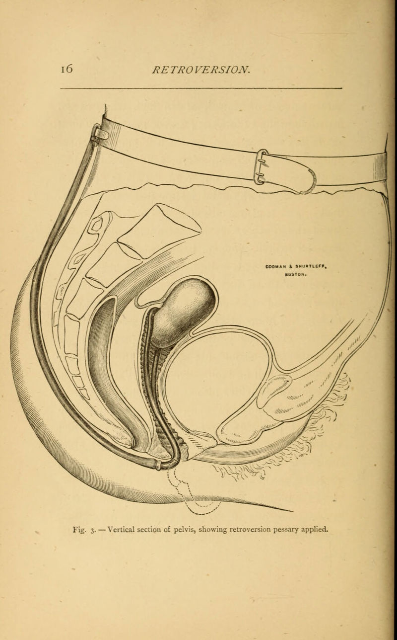 Fig. 3. — Vertical section of pelvis, showing retroversion pessary applied.