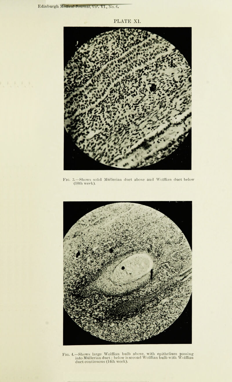 Edinburgh flUHPIflflrSI, W. VJ., iso. (.. PLATE XL Fig. 3.—Shows solid Hiiller (J (tli week). duct above and Wolffian duct below Fig. 4.—Slums targe Wolffian bulb above, with epithelium passing into Mullerian duct; below is second Wolffian bulb with Wolffian duct continuous (14th week).