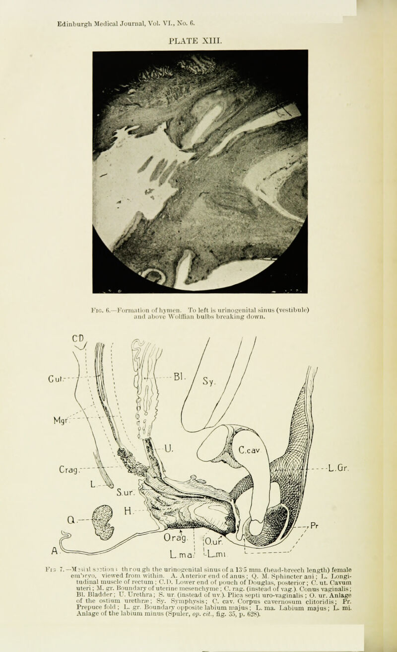 PLATE XIII. I'm. 6. Formation of hymen. To left is urinogenital sinus (vestibule) and above Wolffian bulbs breaking down. -L.Gr. L ma Fis 7.—M3311I B33tiom through the urinogeuital sinus 1 if a 13.5 mm.(head-breech length) female em'irvo, viewed from within. A. Anterior end of anus ; Q. M. Sphincter ani; L. Longi- tudinal muscle 0/rectum ; CD. Lower end of pouch of Douglas, posterior; Cut. Cavum uteri; M. gr. Boundary of uterine mesenchyme; C rag. (instead of vag.). Conus vaginalis; Bl. Bladder; U. Urethra; S. ur (instead of uv). Plica septi uro-vagihalis ; O. ur. Anlage of the ostium urethra?; Sy. Symphysis; C cav. Corpus caveniosum clitoridis; Pr. Prepuce fold ; L. gr. Boundary opposite labium majus; L. ma. Labium majus; L. mi. Anlage of the labium minus (Spuler, op. at., fig. 3.5, p. 628).