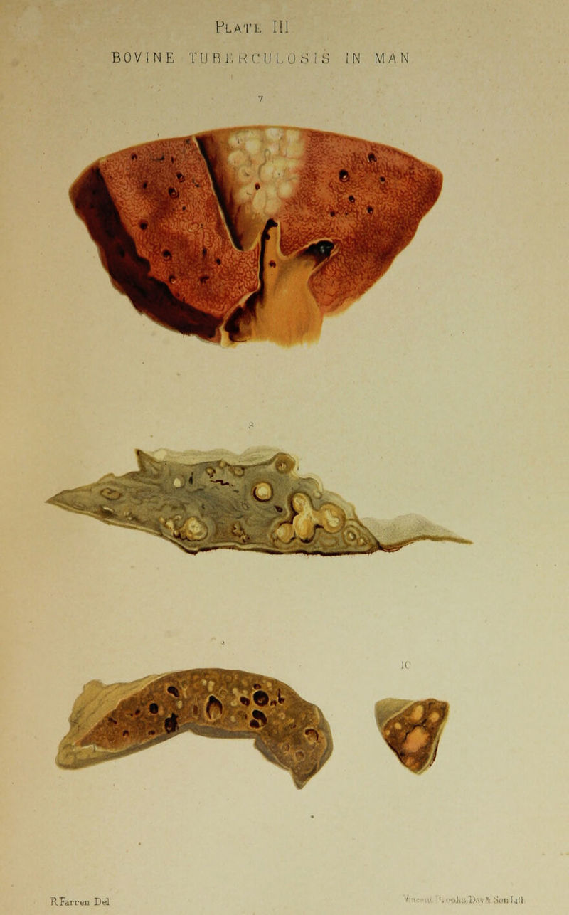 Plat i:. III BOVINE TUBERCULOSIS IN MAN &9 RFarren Del .; .. Dm '■ .''nil lull