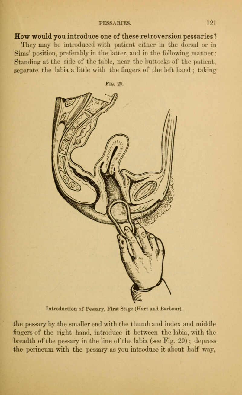 How would you introduce one of these retroversion pessaries? They may be introduced with patient either in the dorsal or in Sims' position, preferably in the latter, and in the following manner: Standing at the ride of the table, near the buttocks of the patient, Beparate the labia a little with the fingers of the left hand ; taking Fig. 29. Introduction of Pessary, First Stage (Hart and Barbour). the pessary by the smaller end with the thumb and index and middle fingers of the right hand, introduce it between the labia, with the breadth of the pessary in the line of the labia (see Fig. 29); depress the perineum with the pessary as you introduce it about half way,