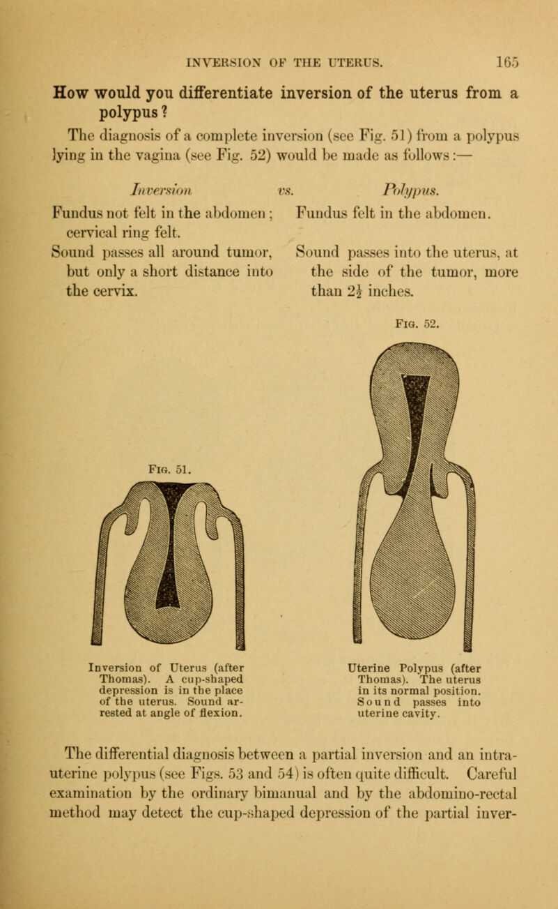 How would you differentiate inversion of the uterus from a polypus ? The diagnosis of a complete inversion (see Fig. 51) from a polypus lying in the vagina (see Fig. 52) would be made as follows:— Inversion vs. Polypus. Fundus not felt in the abdomen : Fundus felt in the abdomen, cervical ring felt. Sound passes all around tumor, Sound passes into the uterus, at but only a short distance into the side of the tumor, more the cervix. than 2 J inches. Fig. 52. Fig. 51. Inversion of Uterus (after Thomas). A cup-shaped depression is in the place of the uterus. Sound ar- rested at angle of flexion. Uterine Polypus (after Thomas). The uterus in its normal position. Sound passes into uterine cavity. The differential diagnosis between a partial inversion and an intra- uterine polypus (sec Pigs. 53 and 54) is often quite difficult. Careful examination by the ordinary bimanual and by the abdomino-rectal method may detect the cup-shaped depression of the partial inver-