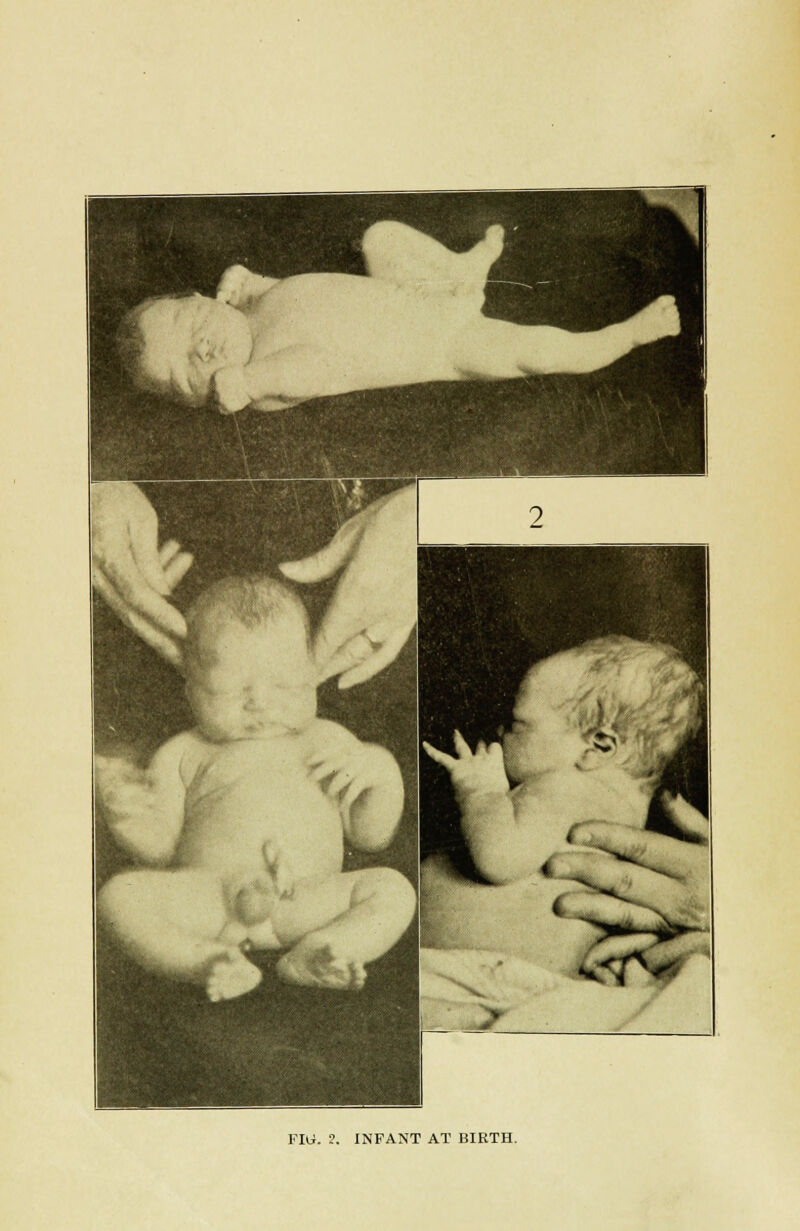 FIG. ?. INFANT AT BIRTH.