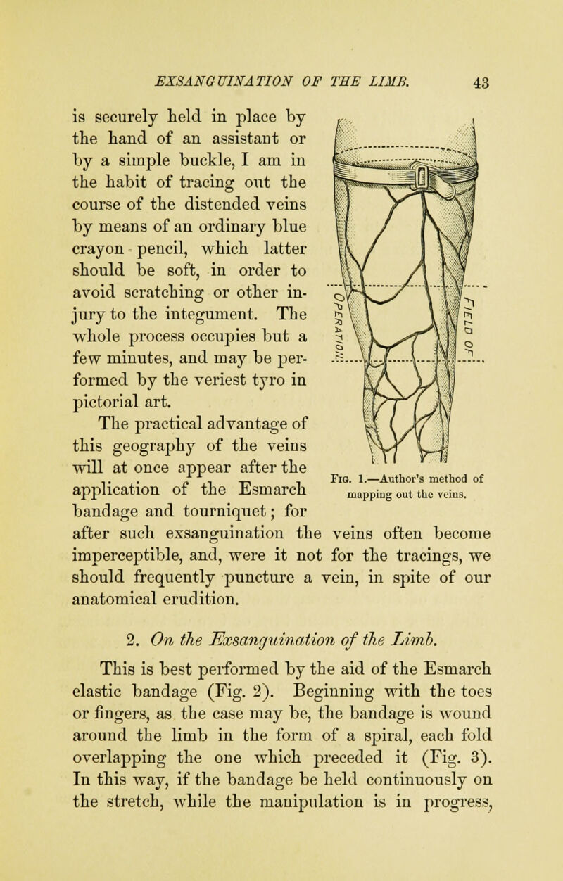 is securely held in place by the hand of an assistant or by a simple buckle, I am in the habit of tracing out the course of the distended veins by means of an ordinary blue crayon pencil, which latter should be soft, in order to avoid scratching or other in- jury to the integument. The whole process occupies but a few minutes, and may be per- formed by the veriest tyro in pictorial art. The practical advantage of this geography of the veins will at once appear after the application of the Esmarch bandage and tourniquet; for after such exsanguination the veins often become imperceptible, and, were it not for the tracings, we should frequently puncture a vein, in spite of our anatomical erudition. Fiq. 1.—Author's method of mapping out the reins. 2. On the Exsanquination of the Limb. This is best performed by the aid of the Esmarch elastic bandage (Fig. 2). Beginning with the toes or fingers, as the case may be, the bandage is wound around the limb in the form of a spiral, each fold overlapping the one which preceded it (Fig. 3). In this way, if the bandage be held continuously on the stretch, while the manipulation is in progress,