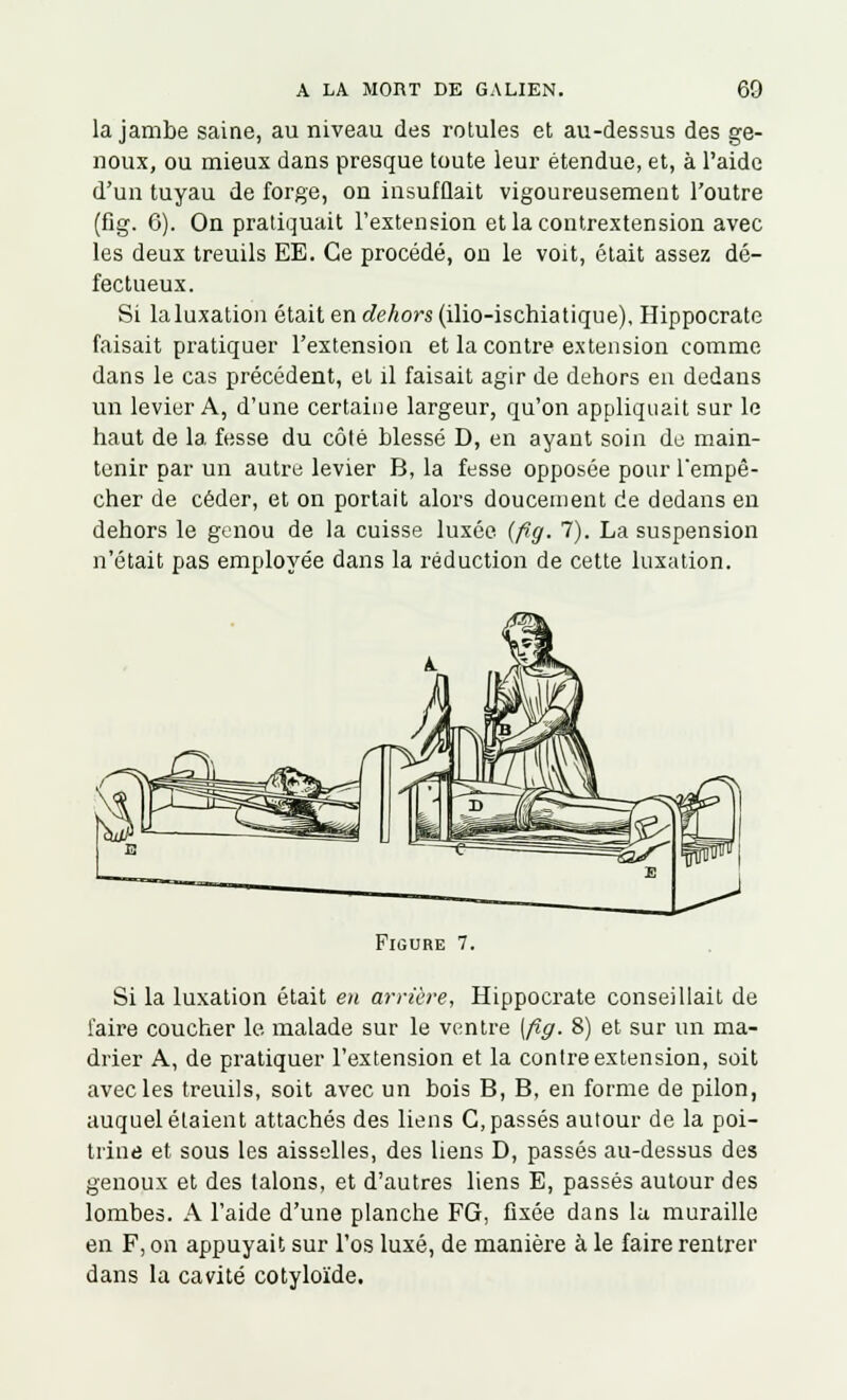 la jambe saine, au niveau des rotules et au-dessus des ge- noux, ou mieux dans presque toute leur étendue, et, à l'aide d'un tuyau de forge, on insufflait vigoureusement l'outre (fig. 6). On pratiquait l'extension etlacontrextension avec les deux treuils EE. Ce procédé, on le voit, était assez dé- fectueux. Si la luxation était en dehors (ilio-ischiatique), Hippocrate faisait pratiquer l'extension et la contre extension comme dans le cas précédent, et il faisait agir de dehors en dedans un levier A, d'une certaine largeur, qu'on appliquait sur le haut de la. fesse du côté blessé D, en ayant soin de main- tenir par un autre levier B, la fesse opposée pour Tempê- cher de céder, et on portait alors doucement de dedans en dehors le genou de la cuisse luxée (fig. 7). La suspension n'était pas employée dans la réduction de cette luxation. Figure 7. Si la luxation était en arrière, Hippocrate conseillait de l'aire coucher le malade sur le ventre [fig. 8) et sur un ma- drier A, de pratiquer l'extension et la contre extension, soit avec les treuils, soit avec un bois B, B, en forme de pilon, auquel étaient attachés des liens G, passés autour de la poi- trine et sous les aisselles, des liens D, passés au-dessus des genoux et des talons, et d'autres liens E, passés autour des lombes. A l'aide d'une planche FG, fixée dans la muraille en F, on appuyait sur l'os luxé, de manière à le faire rentrer dans la cavité cotyloïde.