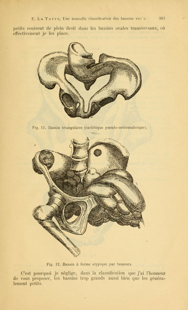 petits rentrent de plein droit dans les bassins ovales transversaux, où effectivement je les place. Fig. 11. Bassin triangulaire (rachitique pseudo-ostéomalicique). Fig. 12. Bassin à forme atypique par tumeurs. C'est pourquoi je néglige, dans la classification que j'ai l'honneur de vous proposer, les bassins trop grands aussi bien que les généra- lement petits.