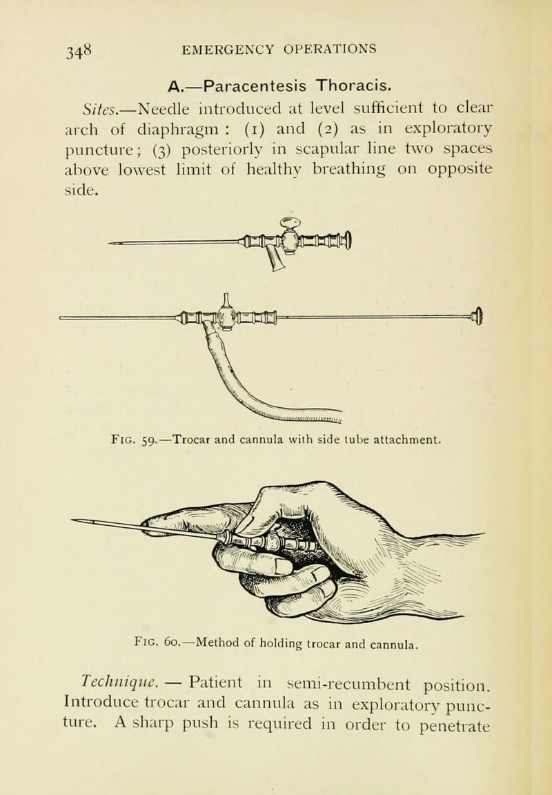 A.—Paracentesis Thoracis. Sites.—Needle introduced ;it level sufficient to clear arch of diaphragm : (i) and (2) as in exploratory puncture; (3) posteriorly in scapular line two spaces above lowest limit of healthy breathing on opposite side. Fig. 59.—Trocar and cannula with side lube attachment. Fig. 60.—Method of holding trocar and cannula. Technique. — Patient in semi-recumbent position. Introduce trocar and cannula as in exploratory punc- ture. A sharp push is required in order to penetrate