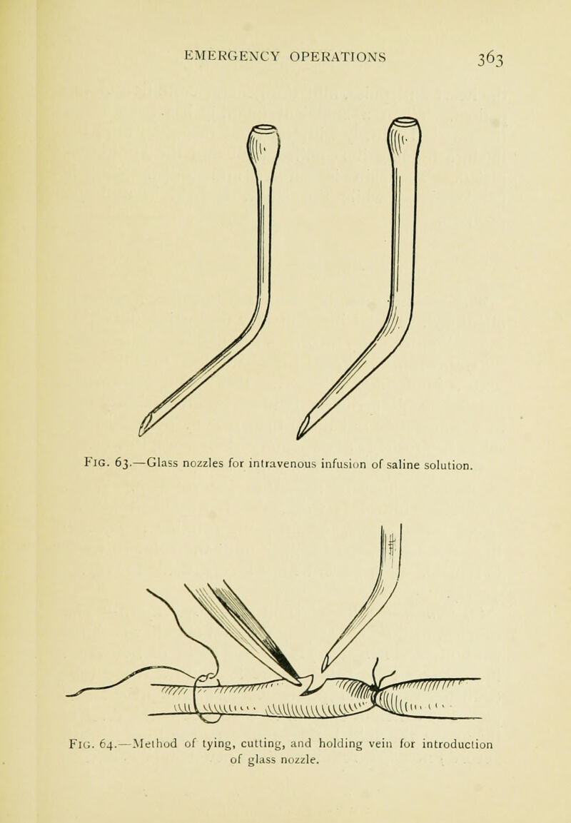 Fia. 63.—Glass nozzles for inlravenous infusion of saline solutio Fig. 64.—Method of lying, cutling, and holding vein fur introduction of glass nozzle.