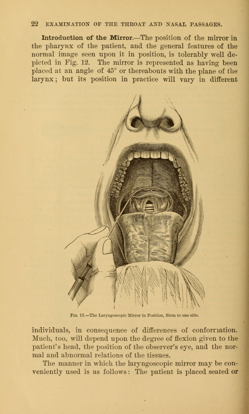 Introduction of the Mirror.—The position of the mirror in the pharynx of the patient, and the general features of the normal image seen upon it in position, is tolerably well de- picted in Fig. 12. The mirror is represented as having been placed at an angle of 45° or thereabouts with the plane of the larynx; but its position in practice will vary in different Fig. 12.—The Laryngoscopy Mirror in Position, Stem to one side. individuals, in consequence of differences of conformation. Much, too, will depend upon the degree of flexion given to the patient's head, the position of the observer's eye, and the nor- mal and abnormal relations of the tissues. The manner in which the laryngoscopy mirror may be con- veniently used is as follows: The patient is placed seated or