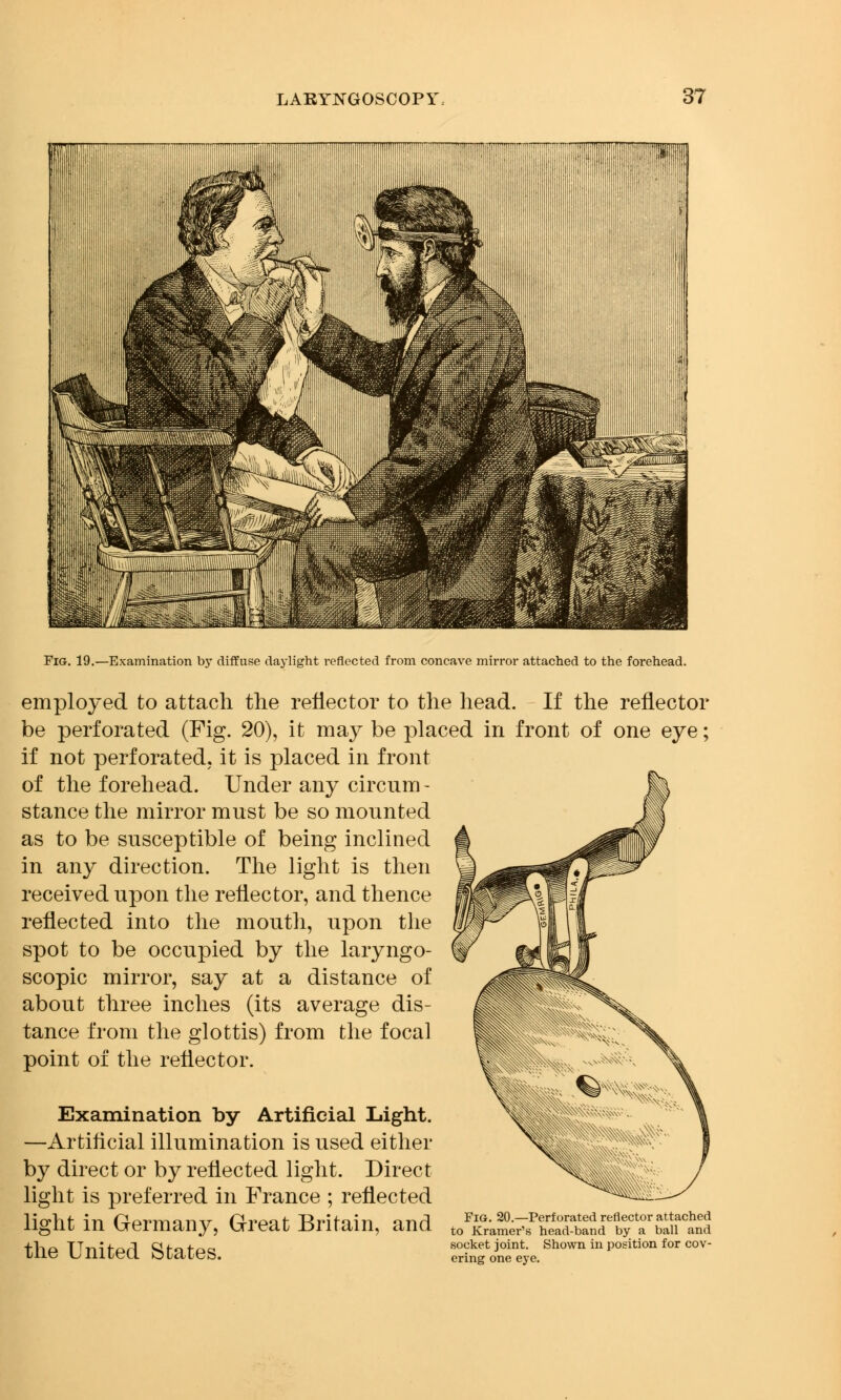 lllllllllllllllllllll Fig. 19.—Examination by diffuse daylight reflected from concave mirror attached to the forehead. employed to attach the reflector to the head. If the reflector be perforated (Fig. 20), it may be placed in front of one eye; if not perforated, it is placed in front of the forehead. Under any circnm - stance the mirror must be so mounted as to be susceptible of being inclined in any direction. The light is then received upon the reflector, and thence reflected into the mouth, upon the spot to be occupied by the laryngo- scopy mirror, say at a distance of about three inches (its average dis- tance from the glottis) from the focal point of the reflector. Examination by Artificial Light. —Artificial illumination is used either by direct or by reflected light. Direct light is preferred in France ; reflected light in Germany, Great Britain, and to^5tf*5SSTEfSPS! the United States. SSffS*shown *P°siti°n f°r c°v