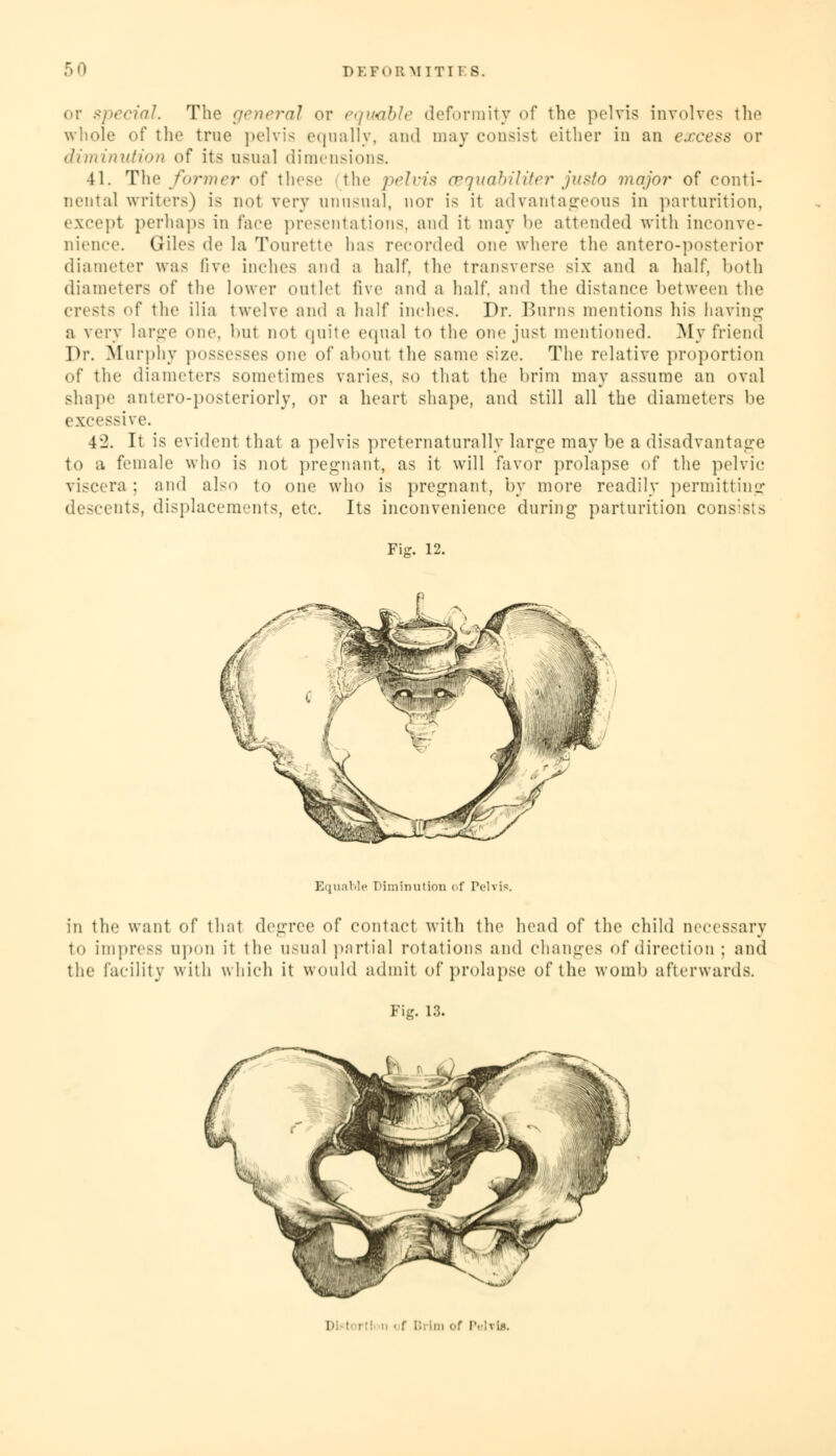 or special. The general or equable deformity of the pelvis involves the whole of the true pelvis equally, and may consist either in an excess or diminution of its usual dimensions. 41. The former of these the pelvis oequabiliter justo major of conti- nental writers) is not very unusual, nor is it advantageous in parturition, except perhaps in face presentations, and it may be attended with inconve- nience. Giles de la Tourette has recorded one where the antero-posterior diameter was live inches and a half, the transverse six and a half, both diameters of the lower outlet five and a half, and the distance between the crests o\ the ilia twelve and a half inches. Dr. Burns mentions his having a very large one, hut not quite equal to the one just mentioned. My friend Dr. Murphy possesses one of about the same size. The relative proportion .if the diameters sometimes varies, so that the brim may assume an oval shape antero-posteriorly, or a heart shape, and still all the diameters be excessive. 42. It is evident that a pelvis preternaturally large may be a disadvantage to a female who is not pregnant, as it will favor prolapse of the pelvic viscera : and also to one who is pregnant, by more readily permitting descents, displacements, etc. Its inconvenience during parturition consists Fix. 12. Equable Diminution of Pelvis. in the want of that degree of contact with the head of the child necessary to impress upon it the usunl partial rotations and changes of direction ; and the facility with which it would admit of prolapse of the womb afterwards. Fig. 1.3. I ■ f I:, im of Pelrli.