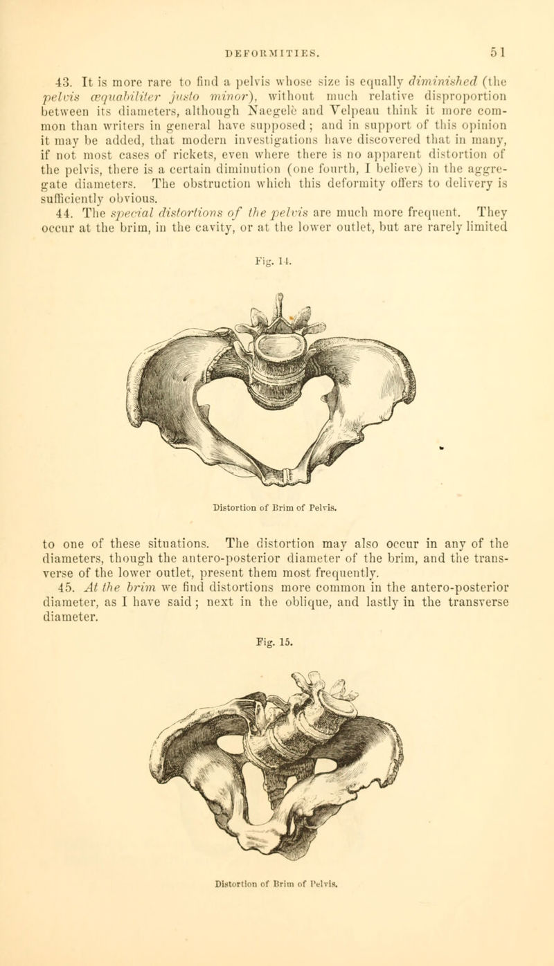 43. It is more rare to find a pelvis whose size is equally diminished (the pelvis cequabiliter junto minor), without much relative disproportion between its diameters, although Naegele and Velpeau think it more com- mon than writers in general have supposed; and in supporl of this opinion it may be added, that modem investigations have discovered that in many, if not most cases of rickets, even where there is no apparent distortion of the pelvis, there is a certain diminution (one fourth, 1 believe; in the aggre- gate diameters. The obstruction which this deformity offers to delivery is sufficiently obvious. 44. The special distortions of the pelvis are much more frequent. They occur at the brim, in the cavity, or at the lower outlet, but are rarely limited Fie. 11. Distortion of Brim of Pelvis. to one of these situations. The distortion may also occur in any of the diameters, though the antero-posterior diameter of the brim, and the trans- verse of the lower outlet, present them most frequently. 45. At the brim we find distortions more common in the antero-posterior diameter, as I have said ; next in the oblique, and lastly in the transverse diameter. Fi<r. 15.