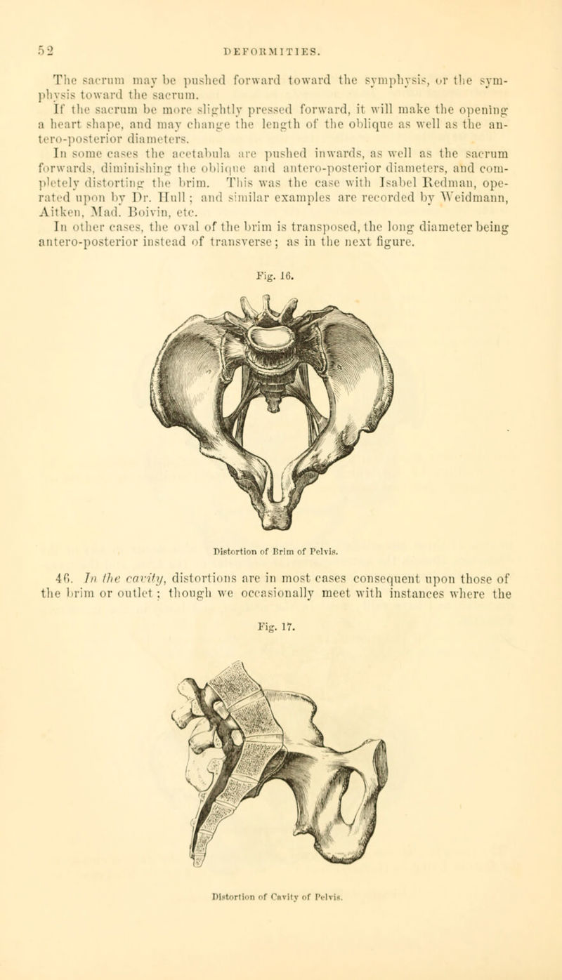 The sacrum may be pushed forward toward the symphysis, or the sym- physis toward the sacrum. If the sacrum be more slightly pressed forward, it will make the opening a heart shape, and may change tin' length of the oblique as well as the an- teroposterior diameters. In some cases the acetabula arc pushed inwards, as well as the sacrum forwards, diminishing the oblique and antero-posterior diameters, and com- pletely distorting the brim. This was the case with Isabel Redman, ope- rated upon by Dr. Hull ; and similar examples are recorded by Weidmann, Aitken. Mad. Boivin, etc. In other cases, the oval of the brim is transposed, the long diameter being antero-posterior instead of transverse; as in the next figure. Fig. 16. Diptortion of Brim of Pelvis. 40. /// the cavity, distortions are in most cases consequent upon those of the brim or outlet ; though we occasionally meet with instances where the Fig. 17.