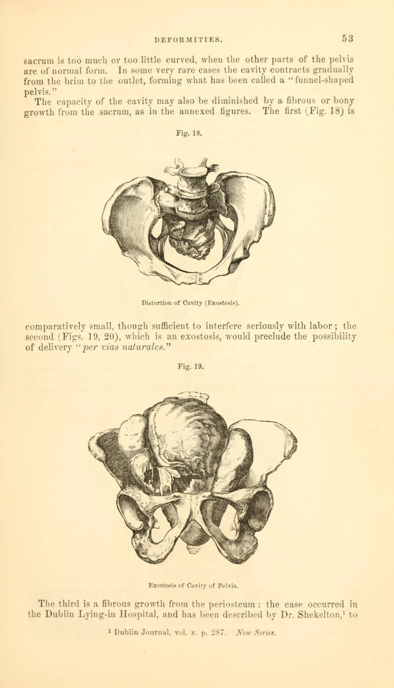 53 sacrum is too much or too little curved, when the other parts of the pelvis are of normal form. In some very rare cases the cavity contracts gradually from the brim to the outlet, forming what has been called a funnel-shaped pelvis. The capacity of the cavity may also be diminished by a fibrous or bony growth from the sacrum, as in the annexed figures. The first (Fig. 18) is Fig. 18. Distortion of Cavity (Exostosis). comparatively small, though sufficient to interfere seriously with labor ; the second (Figs. 19, 20), which is an exostosis, would preclude the possibility of delivery '-per vias naturales. Fig. 19. Exostosis of Cavity of Pelvis. The third is a fibrous growth from the periosteum : the case occurred in ic Dublin Lying-in Hospital, and has been described by Dr. Shekelton,1 to
