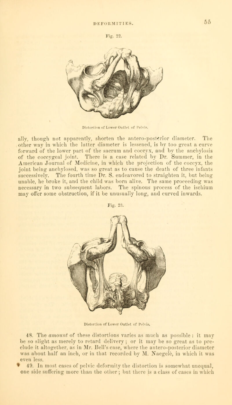 Fie. 22. 00 Distortion of Lower Outlet of I'elvis. ally, though not apparently, shorten the antero-posterior diameter. The other way in which the latter diameter is lessened, is by too great a curve forward of the lower part of the sacrum and coccyx, and by the anchylosis of the coccygeal joint. There is a case related by Dr. Summer, iu the American Journal of Medicine, in which the projection of the coccyx, the joint being anchylosed, was so great as to cause the death of three infants successively. The fourth time Dr. S. endeavored to straighten it, but being unable, he broke it, and the child was born alive. The same proceeding was necessary in two subsequent labors. The spinous process of the ischium may offer some obstruction, if it be unusually long, and curved inwards. Fie. 23. Distortion of Lower Outlet of Pelvis. 48. The amount of these distortions varies as much as possible: it may be so slight as merely to retard delivery ; or it may be so great as to pre- clude it altogether, as in Mr. Bell's case, where the antero-posterior diameter was about half an inch, or iu that recorded by M. Xaegele, in which it was even less. ♦ 41). In most eases of pelvic deformity the distortion i> somewhat unequal, One Bide suffering more than the other; but there is a class of eases in which