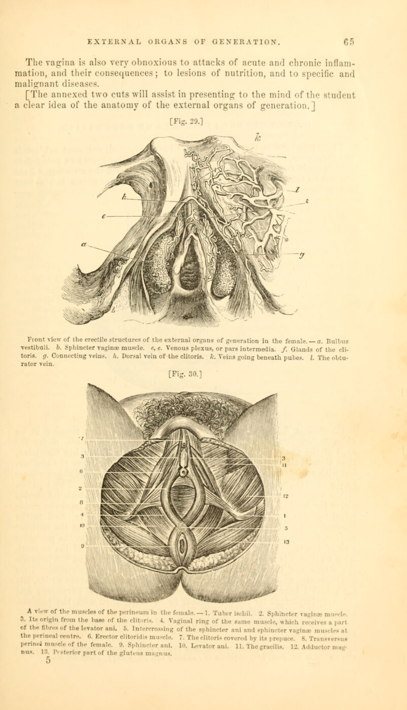 E X T E It N A L oltliANS OF G E N E RATION. 65 The vagina is also very obnoxious to attacks of acute and chronic inflam- mation, and their consequences; to lesions of nutrition, and to Bpecific and malignant diseases. [The annexed two cuts will assisl in presenting to the mind of the Btudent a clear idea of the anatomy of the external organs of generation.] [Fig. 29.] Front view of the erectile structures of the external organs of generation in the female. a. Bulbus vestibuli. b. Sphincter vaginae muscle, e, e. Venous plexus, or pars intermedia. /. Glands of the cli- toris, g. Connecting reins, h. Dorsal vein of the clitoris, k. Veins going beneath pubes. I. The obtu- rator vein. [Fig. 30.] A v'.'w of the muscles of the perineum hi the female. —1. Tub S. [to origin from the base of the clitoris. 4. Vaginal ring of the fibres of the levator ani. 6. intercrossing of the sphincter ani and sphincter vnginse muscl the perinea] centre. 6. Erector clitoridis muscle, nus. 13. P. rterior p.-irt of the glutens magnus. 5 gchu. •_'. Sphincter TaglnsB muccle. lame muscle, e hkh re eh i 7. The clitoris coTered by its prepuce. B. Transi