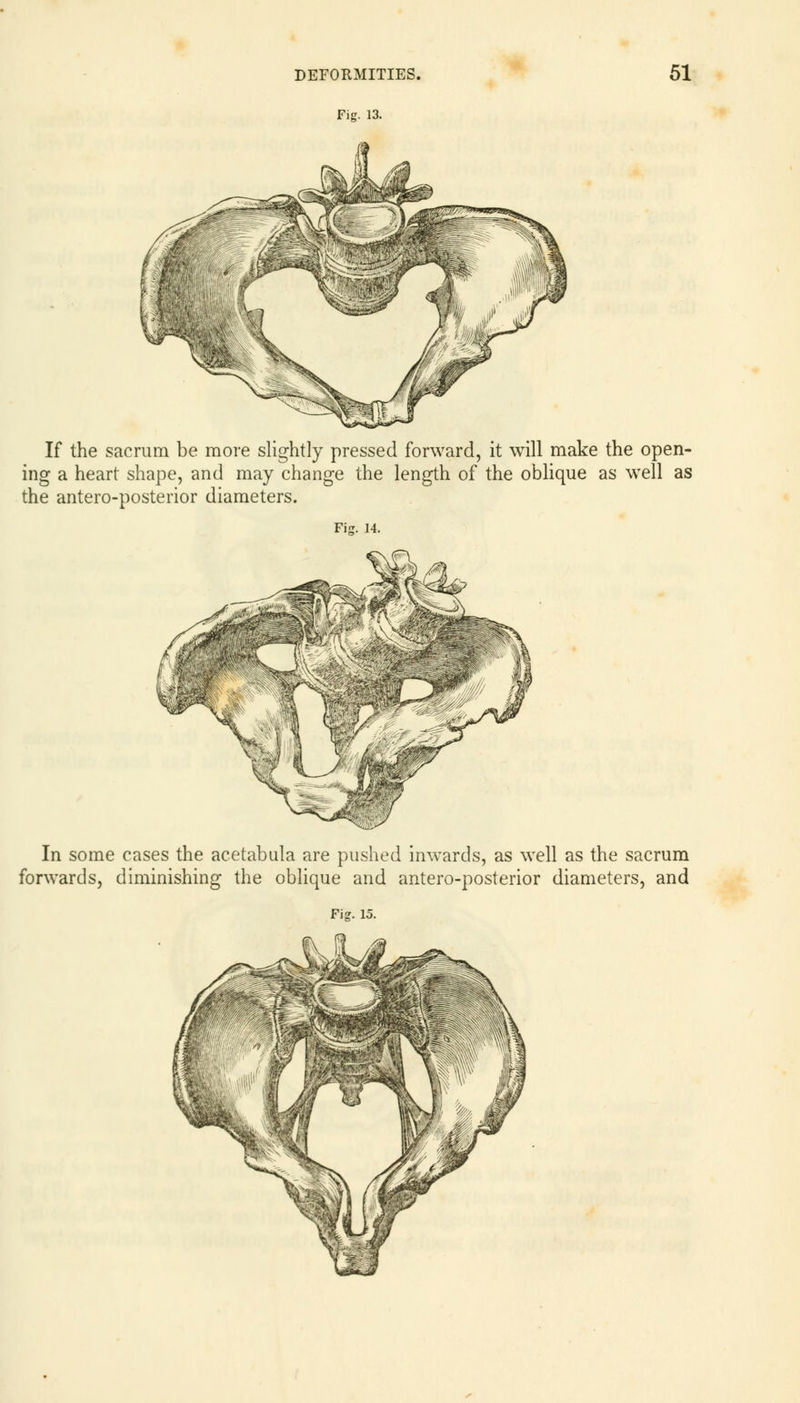 Fig. 13. If the sacrum be more slightly pressed forward, it will make the open- ing a heart shape, and may change the length of the oblique as well as the antero-posterior diameters. Fig. 14. In some cases the acetabula are pushed inwards, as well as the sacrum forwards, diminishing the oblique and antero-posterior diameters, and Fig. 15.