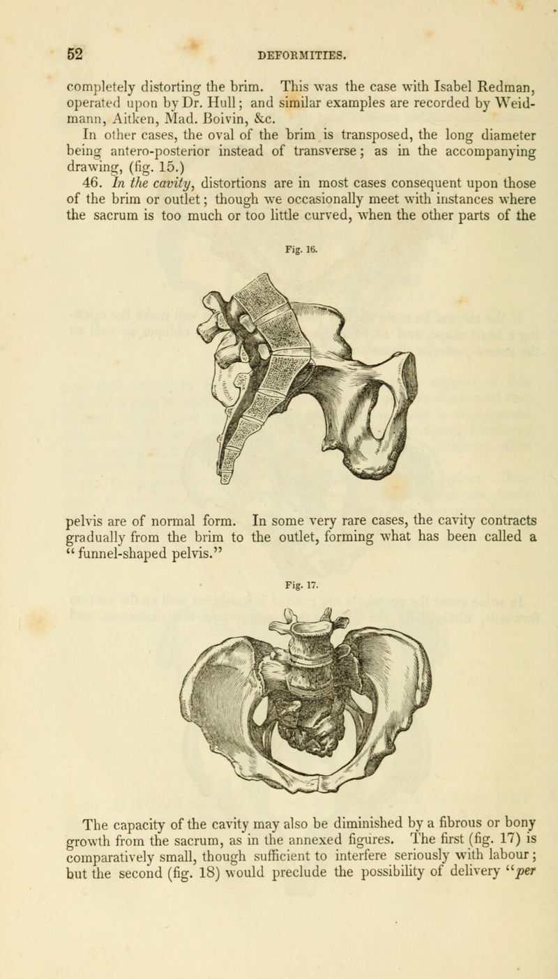 completely distorting the brim. This was the case with Isabel Redman, operated upon by Dr. Hull; and similar examples are recorded by Weid- mann, Aitken, Mad. Boivin, &c. In other cases, the oval of the brim is transposed, the long diameter being antero-posterior instead of transverse; as in the accompanying drawing, (fig. 15.) 46. In the cavity, distortions are in most cases consequent upon those of the brim or outlet; though we occasionally meet with instances where the sacrum is too much or too little curved, when the other parts of the Fig. 16. pelvis are of normal form. In some very rare cases, the cavity contracts gradually from the brim to the outlet, forming what has been called a  funnel-shaped pelvis. Fig. 17. The capacity of the cavity may also be diminished by a fibrous or bony growth from the sacrum, as in the annexed figures. The first (fig. 17) is comparatively small, though sufficient to interfere seriously with labour; but the second (fig. 18) would preclude the possibility of delivery per