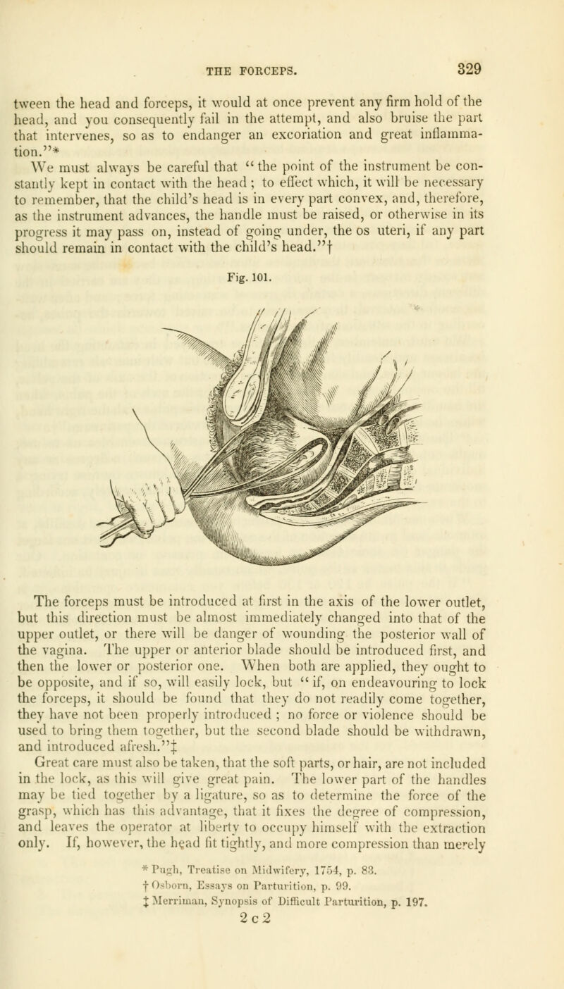 tween the head and forceps, it would at once prevent any firm hold of the head, and you consequently fail in the attempt, and also bruise the part that intervenes, so as to endanger an excoriation and great inflamma- tion.* We must always be careful that  the point of the instrument be con- stantly kept in contact with the head ; to effect which, it will be necessary to remember, that the child's head is in every part convex, and, therefore, as the instrument advances, the handle must be raised, or otherwise in its progress it may pass on, instead of going under, the os uteri, if any part should remain in contact with the child's head.f Fig. 101. The forceps must be introduced at first in the axis of the lower outlet, but this direction must be almost immediately changed into that of the upper outlet, or there will be danger of wounding the posterior wall of the vagina. The upper or anterior blade should be introduced first, and then the lower or posterior one. When both are applied, they ought to be opposite, and if so, will easily lock, but  if, on endeavouring to lock the forceps, it should be found that they do not readily come together, they have not been properly introduced ; no force or violence should be used to bring them together, but the second blade should be withdrawn, and introduced afresh.J Great care must also be taken, that the soft parts, or hair, are not included in the lock, as this will give great pain. The lower part of the handles may be tied together by a ligature, so as to determine the force of the grasp, which has this advantage, that it fixes the degree of compression, and leaves the operator at liberty to occupy himself with the extraction only. If, however, the head fit tightly, and more compression than merely * Pu-li, Treatise on Midwifery, 1754, p. 83. ■j-Osborn, Essays on Parturition, p. 99. J Merriman, Synopsis of Difficult Parturition, p. 197. 2c2