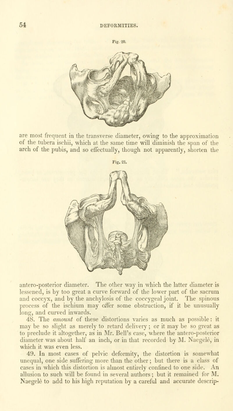 Fig. 20. are most frequent in the transverse diameter, owing to the approximation of the tubera ischii, which at the same time will diminish the span of the arch of the pubis, and so effectually, though not apparently, shorten the Fig. 21. antero-posterior diameter. The other way in which the latter diameter is lessened, is by too great a curve forward of the lower part of the sacrum and coccyx, and by the anchylosis of the coccygeal joint. The spinous process of the ischium may afFer some obstruction, if it be unusually long, and curved inwards. 48. The amount of these distortions varies as much as possible: it may be so slight as merely to retard delivery; or it may be so great as to preclude it altogether, as in Mr. Bell's case, where the antero-posterior diameter was about half an inch, or in that recorded by M. Naegele, in which it was even less. 49. In most cases of pelvic deformity, the distortion is somewhat unequal, one side suffering more than the other; but there is a class of cases in which this distortion is almost entirely confined to one side. An allusion to such will be found in several authors; but it remained for M. Naegele to add to his high reputation by a careful and accurate descrip-