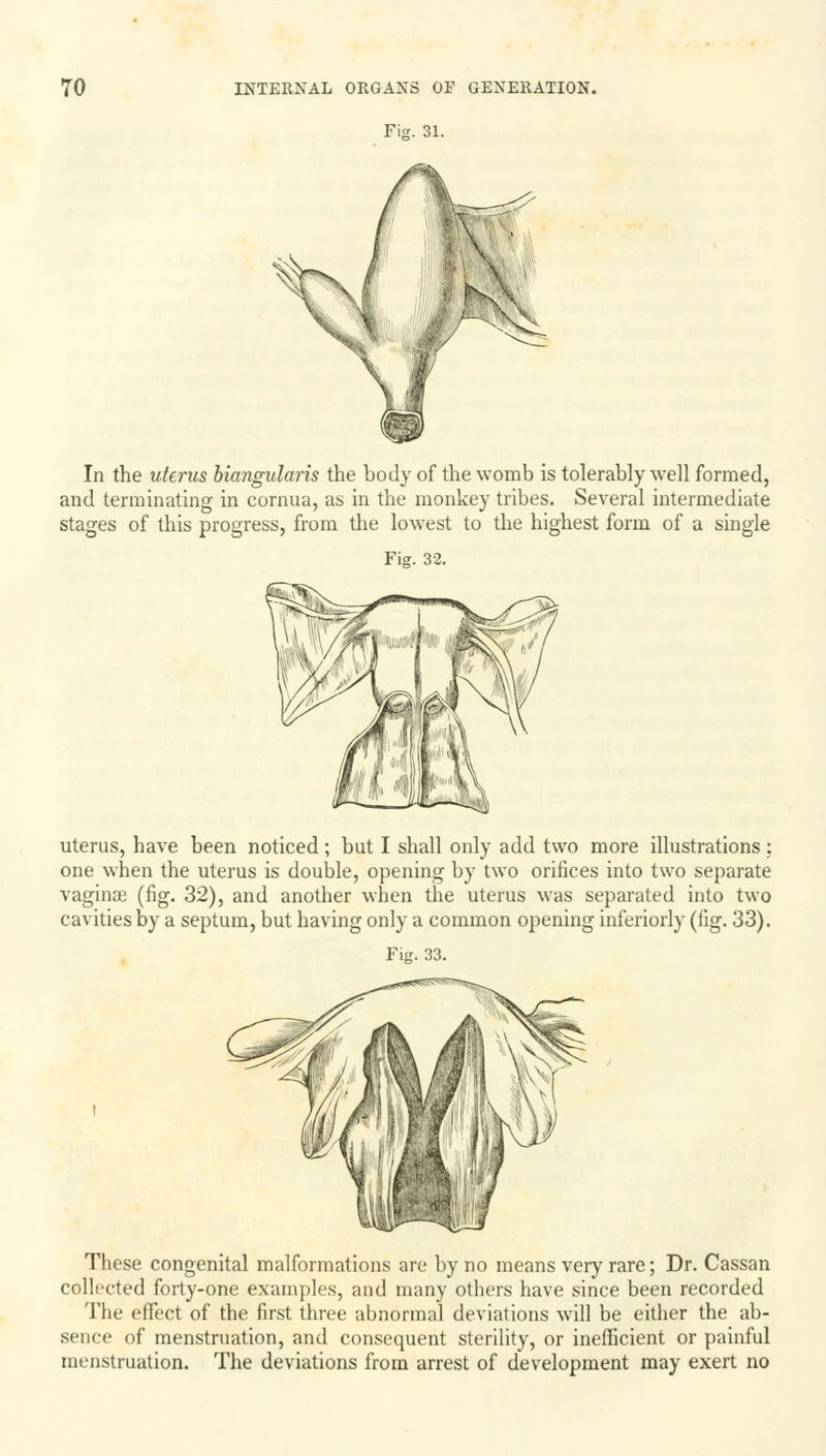 Fisr. 31. In the uterus biangularis the body of the womb is tolerably well formed, and terminating in cornua, as in the monkey tribes. Several intermediate stages of this progress, from the lowest to the highest form of a single uterus, have been noticed; but I shall only add two more illustrations : one when the uterus is double, opening by two orifices into two separate vaginae (fig. 32), and another when the uterus was separated into two cavities by a septum, but having only a common opening inferiorly (fig. 33). Fig. 33. These congenital malformations are by no means very rare; Dr. Cassan collected forty-one examples, and many others have since been recorded The effect of the first three abnormal deviations will be either the ab- sence of menstruation, and consequent sterility, or inefficient or painful menstruation. The deviations from arrest of development may exert no