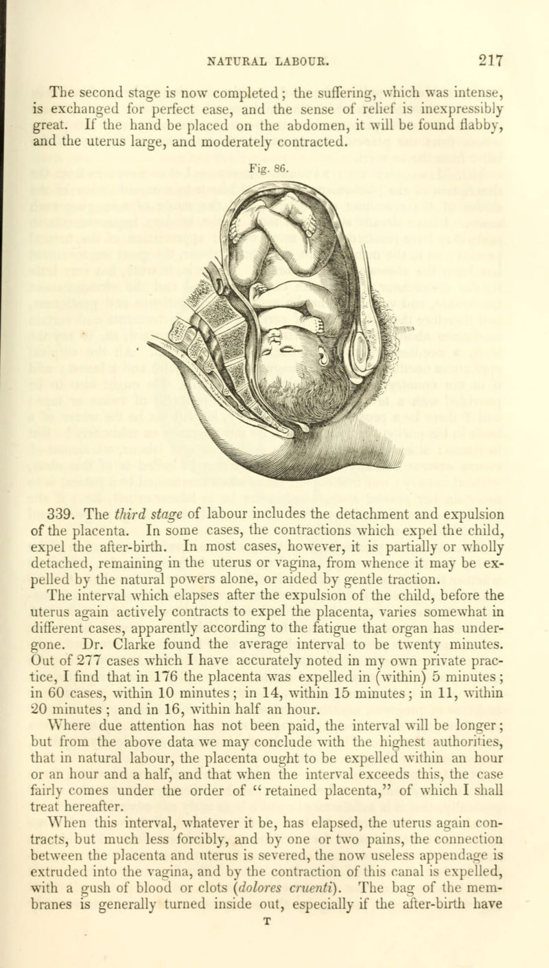 The second stage is now completed; the suffering, which was intense, is exchanged for perfect ease, and the sense of relief is inexpressibly great. If the hand be placed on the abdomen, it will be found flabby, and the uterus large, and moderately contracted. Fig. 86. 339. The third stage of labour includes the detachment and expulsion of the placenta. In some cases, the contractions which expel the child, expel the after-birth. In most cases, however, it is partially or wholly detached, remaining in the uterus or vagina, from whence it may be ex- pelled by the natural powers alone, or aided by gentle traction. The interval which elapses after the expulsion of the child, before the uterus again actively contracts to expel the placenta, varies somewhat in different cases, apparently according to the fatigue that organ has under- gone. Dr. Clarke found the average interval to be twenty minutes. Out of 277 cases which I have accurately noted in my own private prac- tice, I find that in 176 the placenta was expelled in (within) 5 minutes; in 60 cases, within 10 minutes; in 14, within 15 minutes; in 11, within 20 minutes ; and in 16, within half an hour. Where due attention has not been paid, the interval will be longer; but from the above data we may conclude with the highest authorities, that in natural labour, the placenta ought to be expelled within an hour or an hour and a half, and that when the interval exceeds this, the case fairly comes under the order of  retained placenta, of which I shall treat hereafter. When this interval, whatever it be, has elapsed, the uterus again con- tracts, but much less forcibly, and by one or two pains, the connection between the placenta and uterus is severed, the now useless appendage is extruded into the vagina, and by the contraction of this canal is expelled, with a gush of blood or clots (dolores cruciiti). The bag of the mem- branes is generally turned inside out, especially if the after-birth have