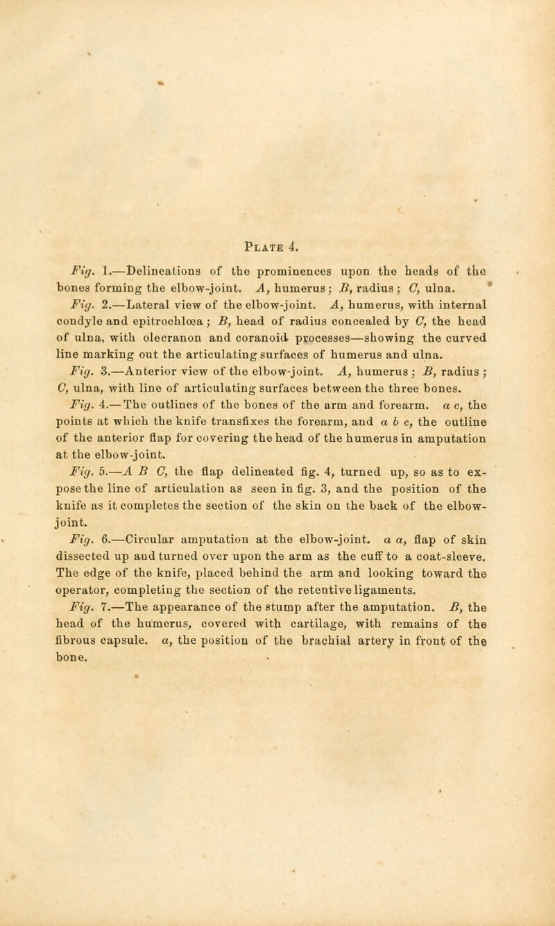 Fig. 1.—Delineations of the prominences upon the heads of the bones forming the elbow-joint. A, humerus ; B, radius ; O, ulna. Fig. 2.—Lateral view of the elbow-joint. A, humerus, with internal condyle and epitrochloea; B, head of radius concealed by G, the head of ulna, with olecranon and coranoid processes—showing the curved line marking out the articulating surfaces of humerus and ulna. Fig. 3.—Anterior view of the elbow-joint. A, humerus ; B, radius ; C, ulna, with line of articulating surfaces between the three bones. Fig. 4.— The outlines of the bones of the arm and forearm, a c, the points at which the knife transfixes the forearm, and a b c, the outline of the anterior flap for covering the head of the humerus in amputation at the elbow-joint. Fig. 5.—A B C, the flap delineated fig. 4, turned up, so as to ex- pose the line of articulation as seen in fig. 3, and the position of the knife as it completes the section of the skin on the back of the elbow- joint. Fig. 6.—Circular amputation at the elbow-joint, a a, flap of skin dissected up and turned over upon the arm as the cuff to a coat-sleeve. The edge of the knife, placed behind the arm and looking toward the operator, completing the section of the retentive ligaments. Fig. 7.—The appearance of the stump after the amputation. B, the head of the humerus, covered with cartilage, with remains of the fibrous capsule, a, the position of the brachial artery in front of the bone.