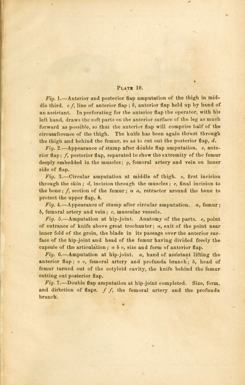 Fig. 1.—Anterior and posterior flap amputation of the thigh in mid- dlo third, c f, line of anterior flap ; b, anterior flap held up by hand of an assistant. In perforating for the anterior flap the operator, with his left hand, draws the soft parts on the anterior surface of the leg as much forward as possible, so that the anterior flap will comprise half of the circumference of the thigh. The knife has been again thrust through the thigh and behind the femur, so as to cut out the posterior flap, d. Fig. 2.—Appearance of stump after double flap amputation, e, ante- rior flap; /, posterior flap, separated to show the extremity of the femur deeply embedded in the muscles; g, femoral artery and vein on inner side of flap. Fig. 3.—Circular amputation at middle of thigh, c, first incision through the skin ; d, incision through the muscles ; e, final incision to the bone; f, section of the femur; a a, retractor around the bone to protect the upper flap, b. Fig. 4.—Appearance of stump after circular amputation, a, femur ; 6, femoral artery and vein; c, muscular vessels. Fig. 5.—Amputation at hip-joint. Anatomy of the parts, c, point of entrance of knife above great trochanter; a, exit of the point near inner fold of the groin, the blade in its passage over the anterior sur- face of the hip-joint and head of the femur having divided freely the capsule of the articulation; a b c, size and form of anterior flap. Fig. 6.—Amputation at hip-joint, a, hand of assistant lifting the anterior flap; c c, femoral artery and profunda branch; b, head of femur turned out of the cotyloid cavity, the knife behind the femur cutting out posterior flap. Fig. 7.—Double flap amputation at hip-joint completed. Size, form, and direction of flaps. / f, the femoral artery and the profunda braueh.