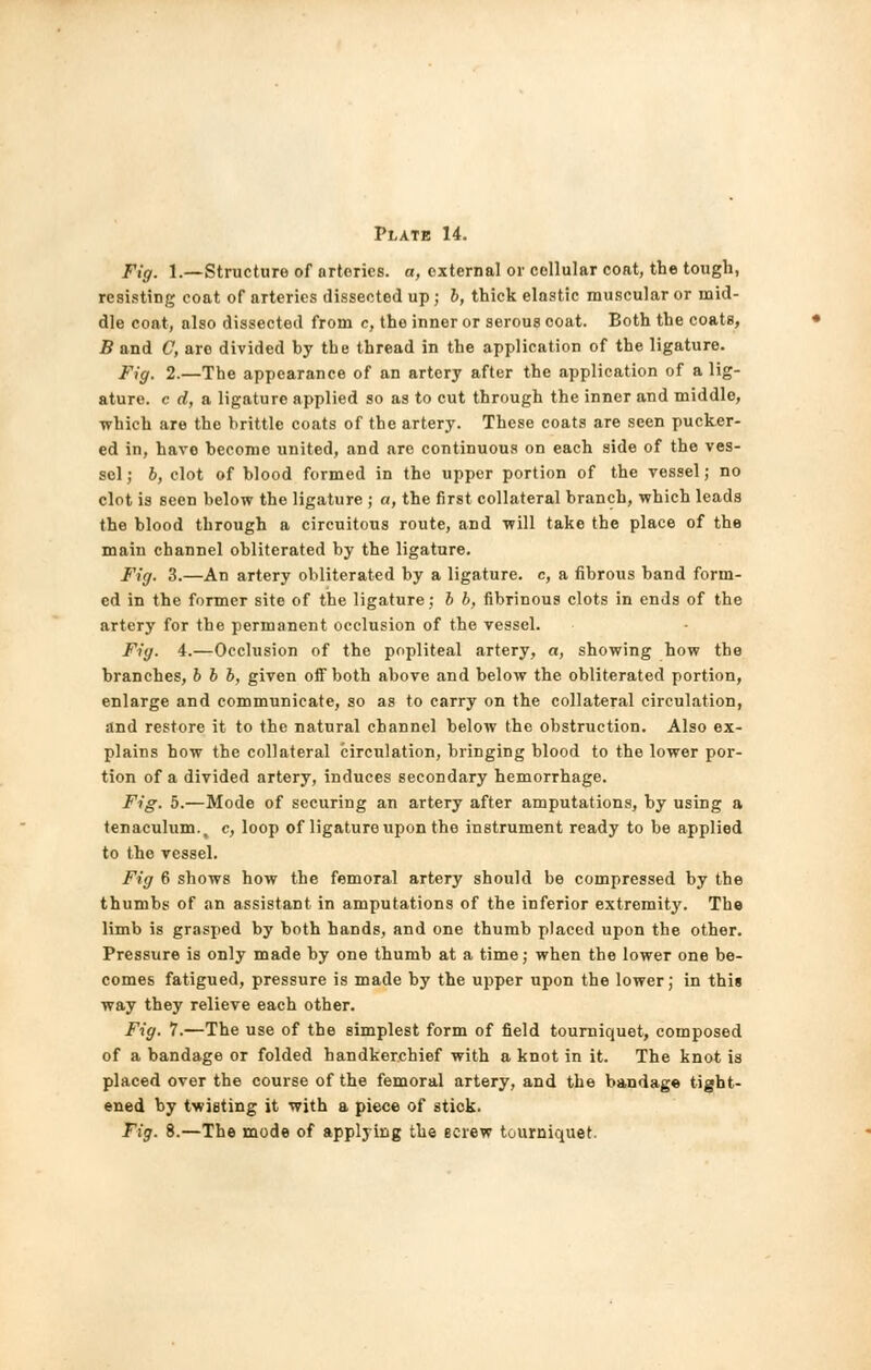 Fig. 1.—Structure of arteries, a, external or cellular coat, the tough, resisting coat of arteries dissected up ; b, thick elastic muscular or mid- dle coat, also dissected from c, the inner or serous coat. Both the coats, B and C, are divided by the thread in the application of the ligature. Fig. 2.—The appearance of an artery after the application of a lig- ature, c d, a ligature applied so as to cut through the inner and middle, which are the brittle coats of the artery. These coats are seen pucker- ed in, haro become united, and are continuous on each side of the ves- sel ; b, clot of blood formed in the upper portion of the vessel; no clot is seen below the ligature ; a, the first collateral branch, which leads the blood through a circuitous route, and will take the place of the main channel obliterated by the ligature. Fig. 3.—An artery obliterated by a ligature, c, a fibrous band form- ed in the former site of the ligature; b b, fibrinous clots in ends of the artery for the permanent occlusion of the vessel. Fig. 4.—Occlusion of the popliteal artery, a, showing how the branches, b b b, given off both above and below the obliterated portion, enlarge and communicate, so as to carry on the collateral circulation, and restore it to the natural channel below the obstruction. Also ex- plains how the collateral circulation, bringing blood to the lower por- tion of a divided artery, induces secondary hemorrhage. Fig. 5.—Mode of securing an artery after amputations, by using a tenaculum., c, loop of ligature upon the instrument ready to be applied to the vessel. Fig 6 shows how the femoral artery should be compressed by the thumbs of an assistant in amputations of the inferior extremity. The limb is grasped by both hands, and one thumb placed upon the other. Pressure is only made by one thumb at a time; when the lower one be- comes fatigued, pressure is made by the upper upon the lower; in this way they relieve each other. Fig. 7.—The use of the simplest form of field tourniquet, composed of a bandage or folded handkerchief with a knot in it. The knot is placed over the course of the femoral artery, and the bandage tight- ened by twisting it with a piece of stick. Fig. 8.—The mode of applying the screw tourniquet.