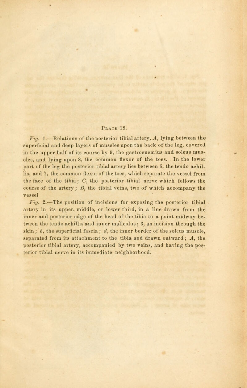 Fig. 1.—Relations of the posterior tibial artery, A, lying between the superficial and deep layers of muscles upon the back of the leg, covered in the upper half of its course by 9, the gastrocnemius and soleus mus- cles, and lying upon 8, the common flexor of the toes. In the lower part of the leg the posterior tibial artery lies between 6, the tendo achil- lis, and 7, the common flexor of the toes, which separate the vessel from the face of the tibia; C, the posterior tibial nerve which follows the course of the artery ; B, the tibial veins, two of which accompany the vessel Fig. 2.—The position of incisions for exposing the posterior tibial artery in its upper, middle, or lower third, in a line drawn from the inner and posterior edge of the head of the tibia to a point midway be- tween the tendo achillis and inner malleolus ; 3, an incision through the skin ; b, the superficial fascia; d, the inner border of the soleus muscle, separated from its attachment to the tibia and drawn outward; A, the posterior tibial artery, accompanied by two veins, and having the pos- terior tibial nerve in its immediate neighborhood.