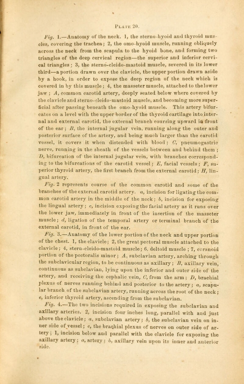 1<'j,j. i.—Anatomy of the nock. 1, the sterno liyoid and thyroid mus- cles, covering the trachea; 2, the omohyoid muscle, running obliquely across the neck from the scapula to the hyoid bone, and forming two triangles of the deep cervical region—the superior and inferior cervi- cal triangles ; 3, the sterno-cleido-mastoid muscle, severed in its lower third—a portion drawn over the clavicle, the upper portion drawn aside by a hook, in order to expose the deep region of the neck which is covered in by this muscle ; 4, the masseter muscle, attached to the lower jaw ; A, common carotid artery, deeply seated below where covered by the clavicle and sterno-oloido-mastoid muscle, and becoming more super- ficial after passing beneath the omo-hyoid muscle. This artery bifur- cates ii a level with the upper border of the thyroid cartilage into inter- nal and external carotid, the external branch coursing upward in front of the ear; U, the internal jugular vein, running along the outer and posterior surface of the artery, and being much larger than the carotid vessel, it covers it when distended with blood; 0, pneumogastric nerve, running in the sheath of the vessels between and behind them ; J), bifurcation of the internal jugular vein, with branches correspond- ing to the bifurcations of the carotid vessel; E, facial vessels ; F, su- perior thyroid artery, the first branch from the external carotid; H, lin- gual artery. Fig. 2 represents course of the common carotid and some of the branches of the external carotid artery, a, incision for ligating the com- mon carotid artery in the middle of the neck; b, incision for exposing the lingual artery; c, incision exposing the facial artery as it runs over the lower jaw, immediately in front of the insertion of the masseter muscle; d, ligation of the temporal artery or terminal brauch of the external carotid, in front of the ear. Fig. 3.—Anatomy of the lower portion of the neck and upper portion of the chest. 1, the clavicle; 2, the great pectoral muscle attached to the clavicle; 4, stern-cleido-mastoid muscle; 6, deltoid muscle ; 7, coranoid portion of the pectoralis minor; A, subclavian artery, arching through the subclavicular region, to be continuous as axillary; B, axillary vein, continuous as subclavian, lying upon the inferior and outer side of the artery, and receiving the cephalic vein, C, from the arm ; D, brachial plexus of nerves running behind and posterior to the artery; a, scapu- lar branch of the subclavian artery, running across the root of the neck ; c, inferior thyroid artery, ascending from the subclavian. Fig. 4.—The two incisions required in exposing the subclavian and axillary arteries. 2, incision four inches long, parallel with and just above the clavicle; a, subclavian artery; b, the subclavian vein on in- ner side ofvessel; c, the brachial plexus of nerves on outer side of ar- tery ; 1, incision below and parallel with the clavicle for exposing the axillary artery; a, artery : 6, axillary vein upon its inner and anterior side.