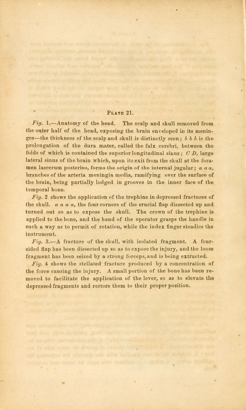 Fig. 1.—Anatomy of the head. The scalp and skull removed from the outer half of the head, exposing the brain enveloped in its menin- ges—the thickness of the scalp and skull is distinctly seen ; b b b is the prolongation of the dura mater, called the falx cerebri, between the folds of which is contained the superior longitudinal sinus; CD, large lateral sinus of the brain which, upon its exit from the skull at the fora- men lascerum postering, forms the origin of the internal jugular; a a a, branches of the arteria meningia media, ramifying over the surface of the brain, being partially lodged in grooves in the inner face of the temporal bone. Fig. 2 shows the application of the trephine in depressed fractures of the skull, a a a a, the four corners of the crucial flap dissected up and turned out so as to expose the skull. The crown of the trephine is applied to the bone, and the hand of the operator grasps the handle in such a way as to permit of rotation, while the index finger steadies the instrument. Fig. 3.—A fracture of the skull, with isolated fragment. A four- sided flap has been dissected up so as to expose the injury, and the loose fragment has been seized by a strong forceps, and is being extracted. Fig. 4 shows the stellated fracture produced by a concentration of the force causing the injury. A small portion of the bone has been re- moved to facilitate the application of the lever, so as to elevate the depressed fragments and restore them to their proper position.