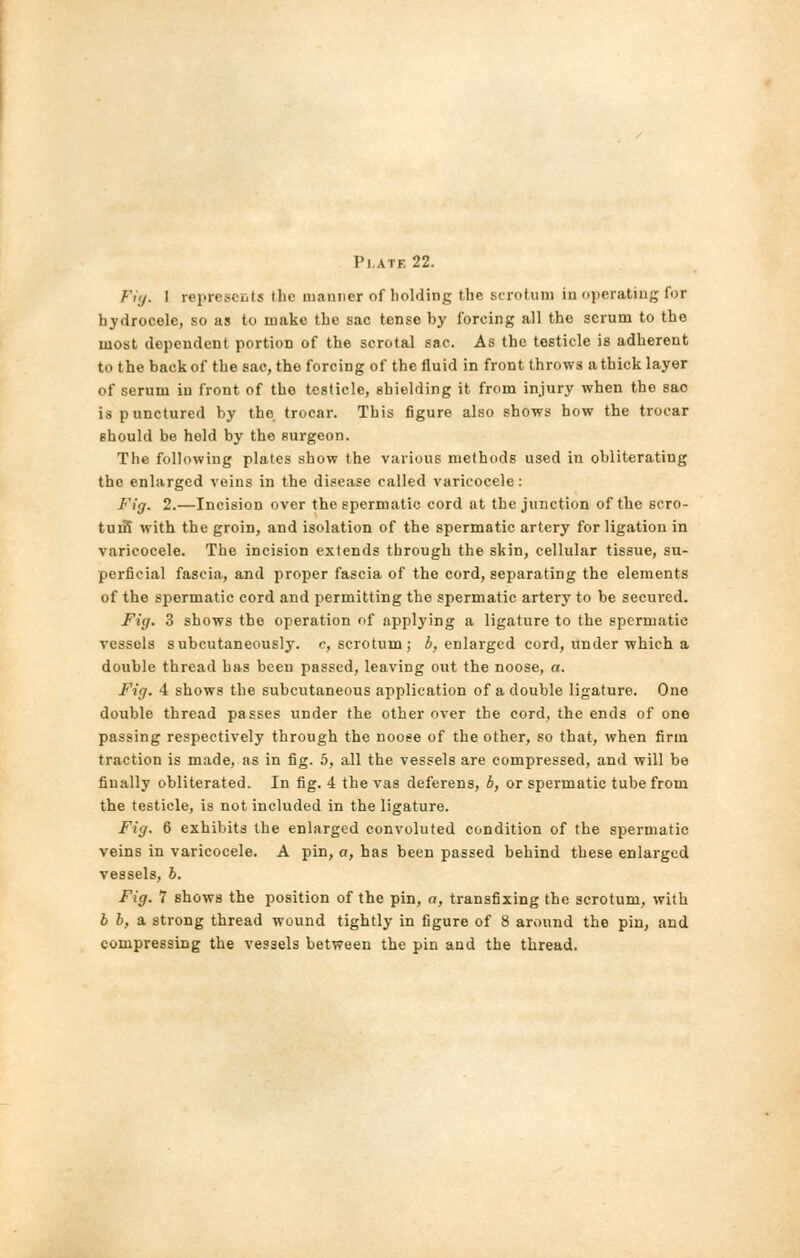 Fig. 1 represents the manner of holding the scrotum in operating for hydrocele, so as to make the sac tense by forcing all the scrum to the most dependent portion of the scrotal sac. As the testicle is adherent to the back of the sac, the forcing of the fluid in front throws a thick layer of serum in front of the testicle, shielding it from injury when the sac is punctured by the trocar. This figure also shows how the trocar should be hold by the surgeon. The following plates show the various methods used in obliterating the enlarged veins in the disease called varicocele: Fig. 2.—Incision over the spermatic cord at the junction of the scro- tum with the groin, and isolation of the spermatic artery for ligation in varicocele. The incision extends through the skin, cellular tissue, su- perficial fascia, and proper fascia of the cord, separating the elements of the spermatic cord and permitting the spermatic artery to be secured. Fig. 3 shows the operation of applying a ligature to the spermatic vessels subcutaneously. c, scrotum; b, enlarged cord, under which a double thread has been passed, leaving out the noose, a. Fig. 4 shows the subcutaneous application of a double ligature. One double thread passes under the other over the cord, the ends of one passing respectively through the noose of the other, so that, when firm traction is made, ns in fig. 5, all the vessels are compressed, and will be finally obliterated. In fig. 4 the vas deferens, b, or spermatic tube from the testicle, is not included in the ligature. Fig. 6 exhibits the enlarged convoluted condition of the spermatic veins in varicocele. A pin, a, has been passed behind these enlarged vessels, b. Fig. 1 shows the position of the pin, a, transfixing the scrotum, with b b, a strong thread wound tightly in figure of 8 around the pin, and compressing the vessels between the pin and the thread.