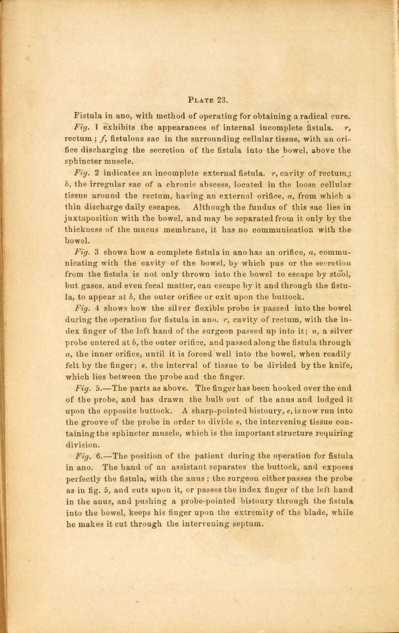Fistula in ano, with method of operating for obtaining a radical cure. Fig. 1 exhibits the appearances of internal incomplete fistula, r, rectum ; /, fistulous sac in the surrounding cellular tissue, with an ori- fice discharging the secretion of the fistula into the bowel, above the sphincter muscle. Fig. 2 indicates an incomplete external fistula, r, cavity of rectum.; b, the irregular sac of a chronic abscess, located in the loose cellular tissue around the rectum, having an external orifice, a, from which a thin discharge daily escapes. Although the fundus of this sac lies in juxtaposition with the bowel, and may be separated from it only by the thickness of the mucus membrane, it has no communication with the bowel. Fig. 3 shows how a complete fistula in ano has an orifice, a, commu- nicating with the cavity of the bowel, b;y which pus or the secretion from the fistula is not only thrown into the bowel to escape by stool, but gases, and even fecal matter, can escape by it and through the fistu- la, to appear at b, the outer orifice or exit upon the buttock. Fig. 4 shows how the silver flexible probe is passed into the bowel during the operation for fistula in ano. r, cavity of rectum, with the in- dex finger of the left hand of the surgeon passed up into it; n, a silver probe entered at b, the outer orifice, and passed along the fistula through a, the inner orifice, until it is forced well into the bowel, when readily felt by the finger; s, the interval of tissue to be divided by the knife, which lies between the probe and the finger. Fig. 5.—The parts as above. The finger has been hooked over the end of the probe, and has drawn the bulb out of the anus and lodged it upon the opposite buttock. A sharp-pointed bistoury, e, is now run into the groove of the probe in order to divide «, the intervening tissue con- taining the sphincter muscle, which is tho important structure requiring division. Fig. 6.—The position of the patient during the operation for fistula in ano. The hand of an assistant separates the buttock, and exposes perfectly the fistula, with the anus ; the surgeon eitherpasses the probe as in fig. 5, and cuts upon it, or passes the index finger of the left hand in the anus, and pushing a probe-pointed bistoury through the fistula into the bowel, keeps his finger upon the extremity of the blade, while he makes it cut through the intervening septum.