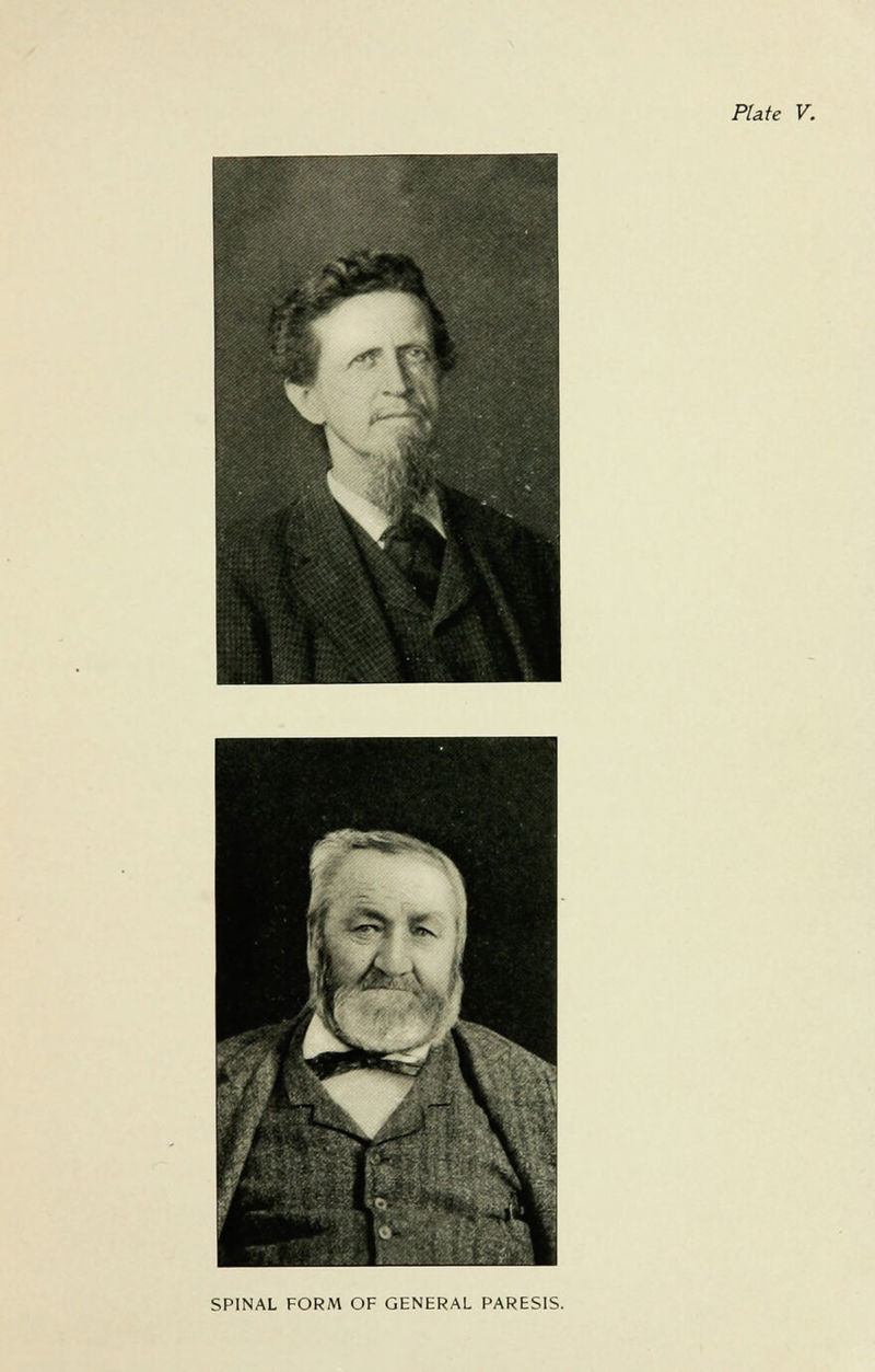 Plate V. SPINAL FORM OF GENERAL PARESIS.