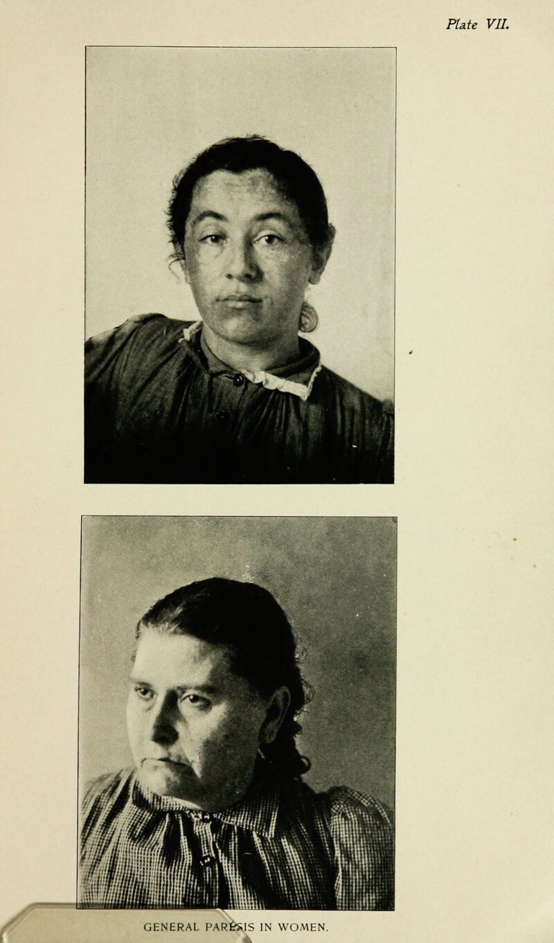 Plate VII. GENERAL PARESIS IN WOMEN.