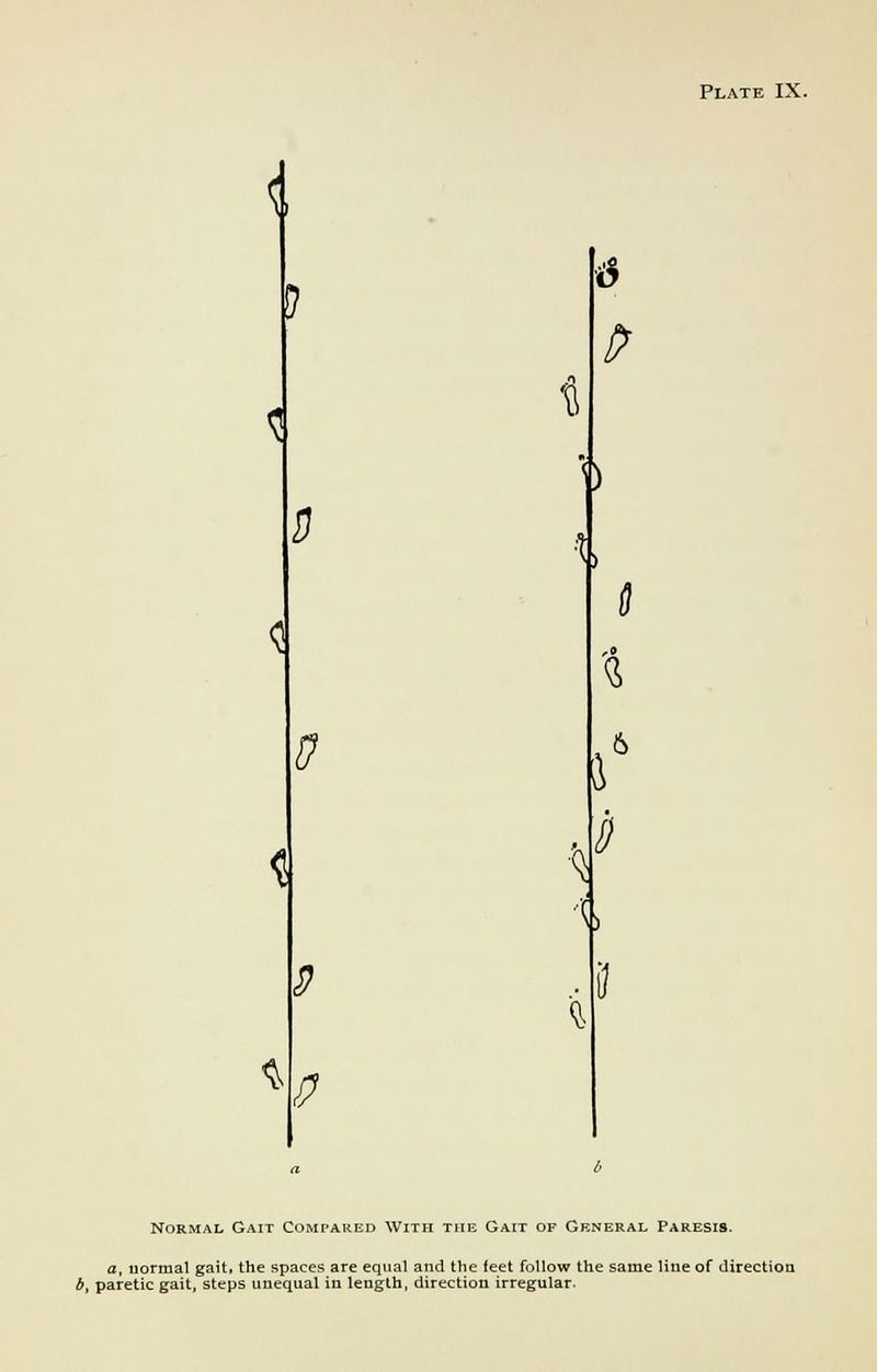 < 0 ,£ *> i \ <s ^ Normal Gait Compared With the Gait of General Paresis. a, normal gait, the spaces are equal and the feet follow the same line of direction b, paretic gait, steps unequal in length, direction irregular.