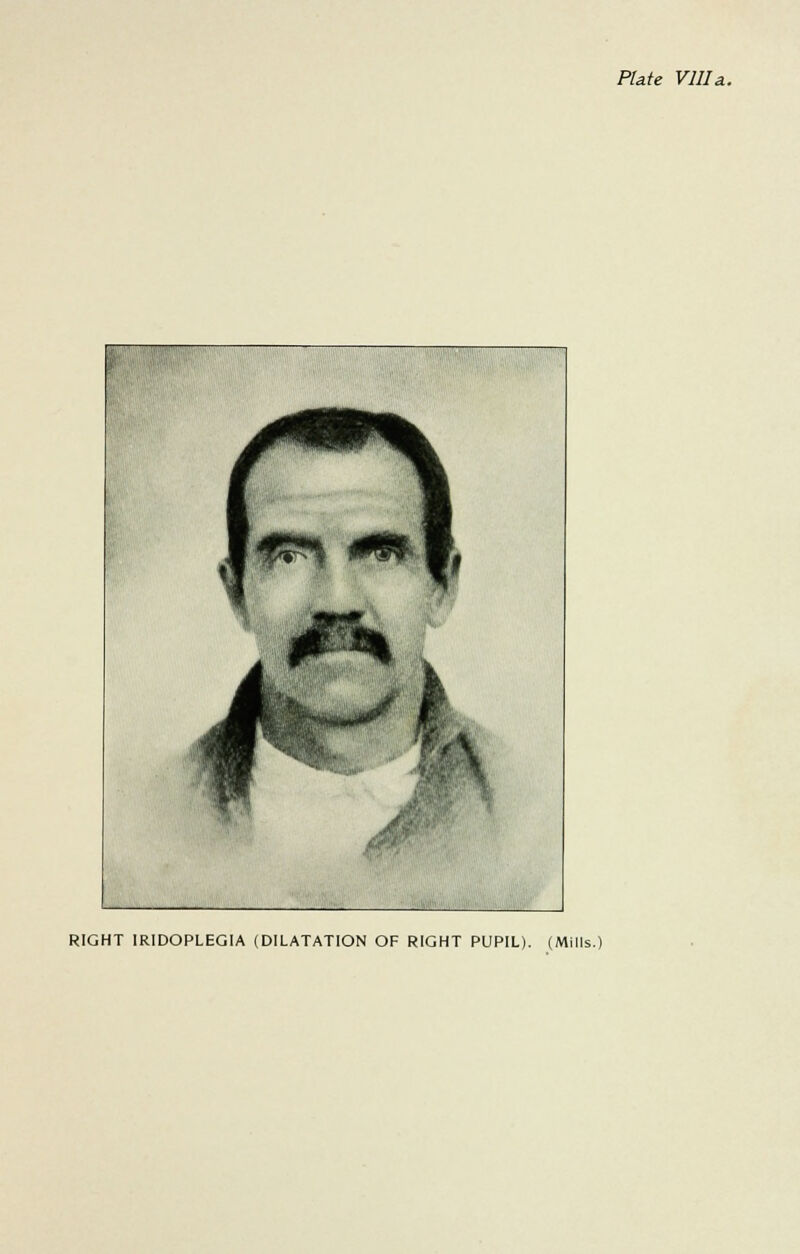 Plate Villa. RIGHT IRIDOPLEGIA (DILATATION OF RIGHT PUPIL). (Mills.)