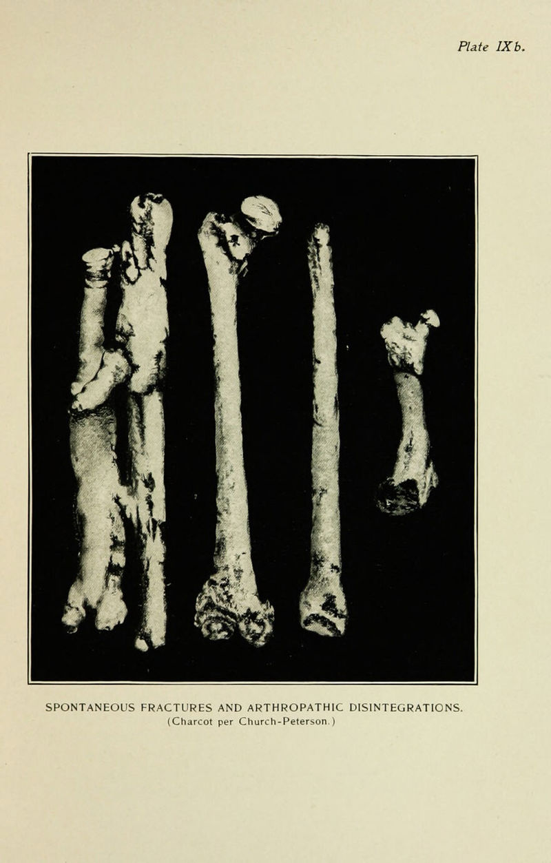 Plate IXb. SPONTANEOUS FRACTURES AND ARTHROPATHIC DISINTEGRATIONS. (Charcot per Church-Peterson )